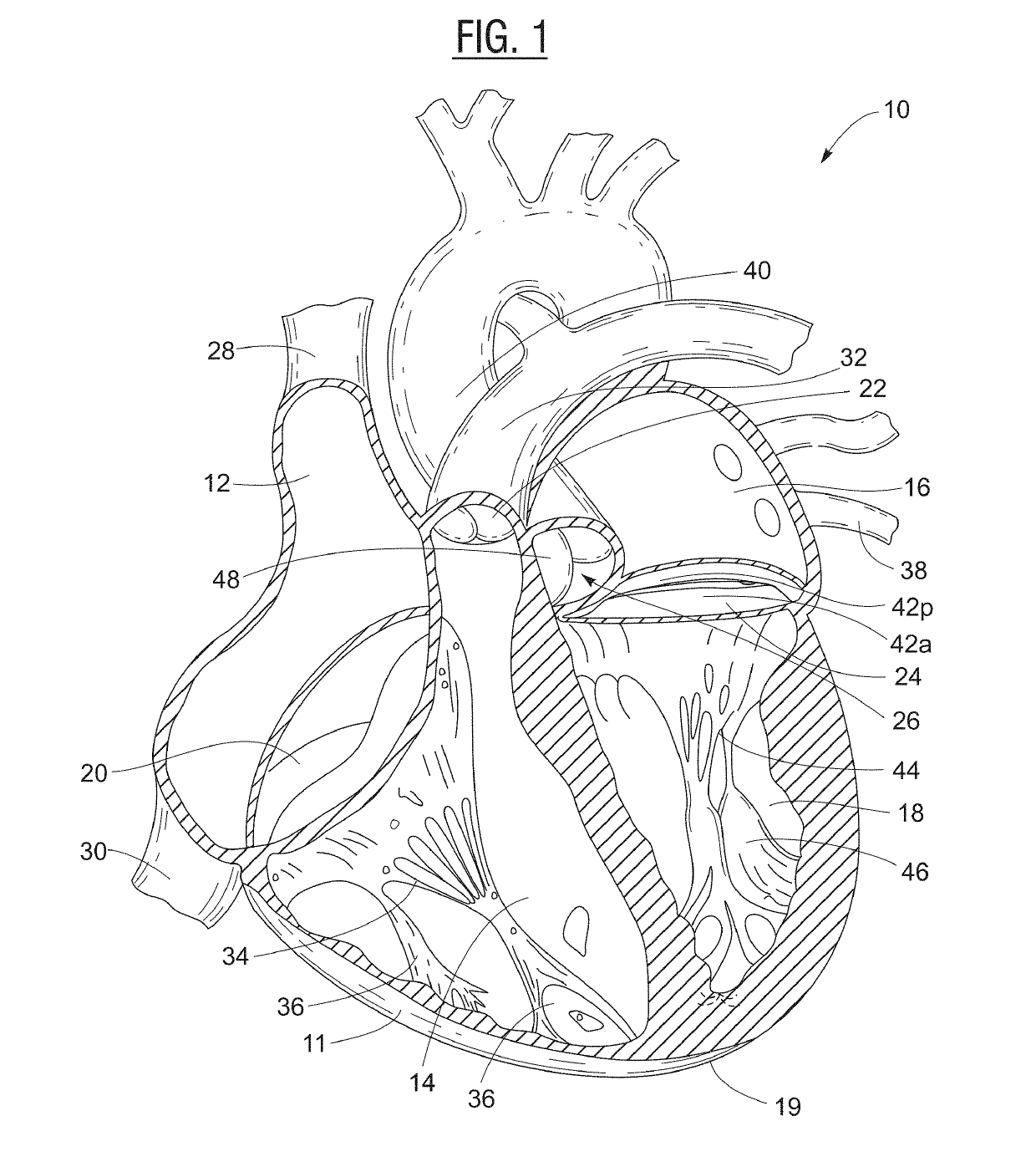 Non-invasive wearable heart valve monitor