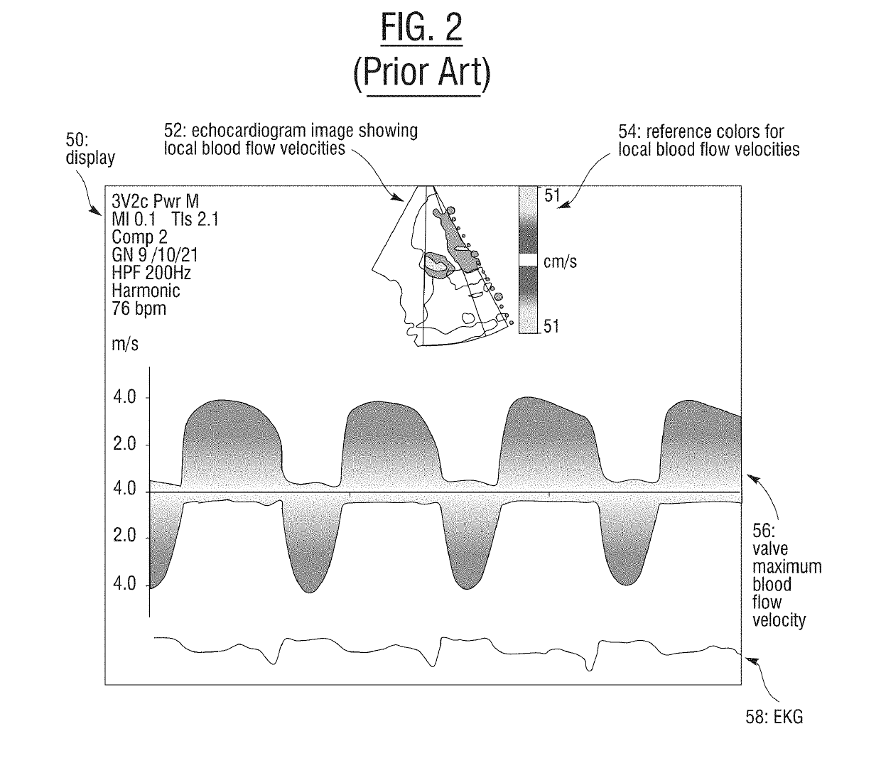 Non-invasive wearable heart valve monitor