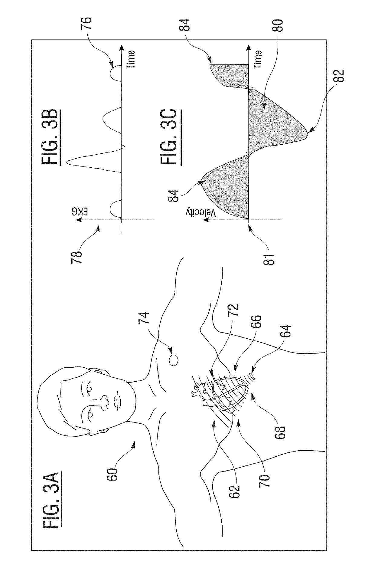 Non-invasive wearable heart valve monitor