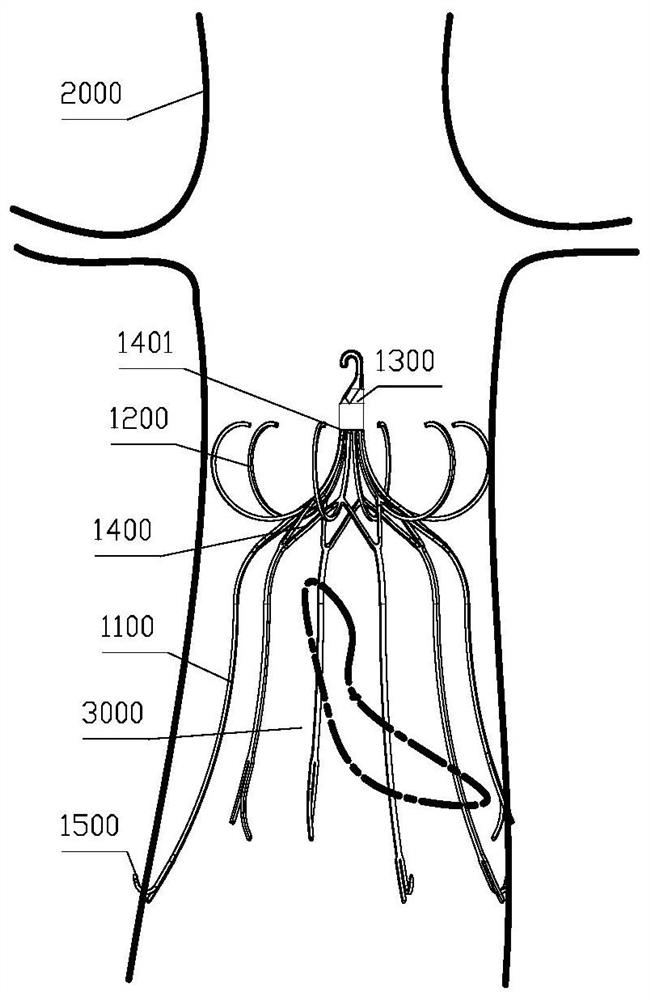 Two-way controlled release vena cava filter