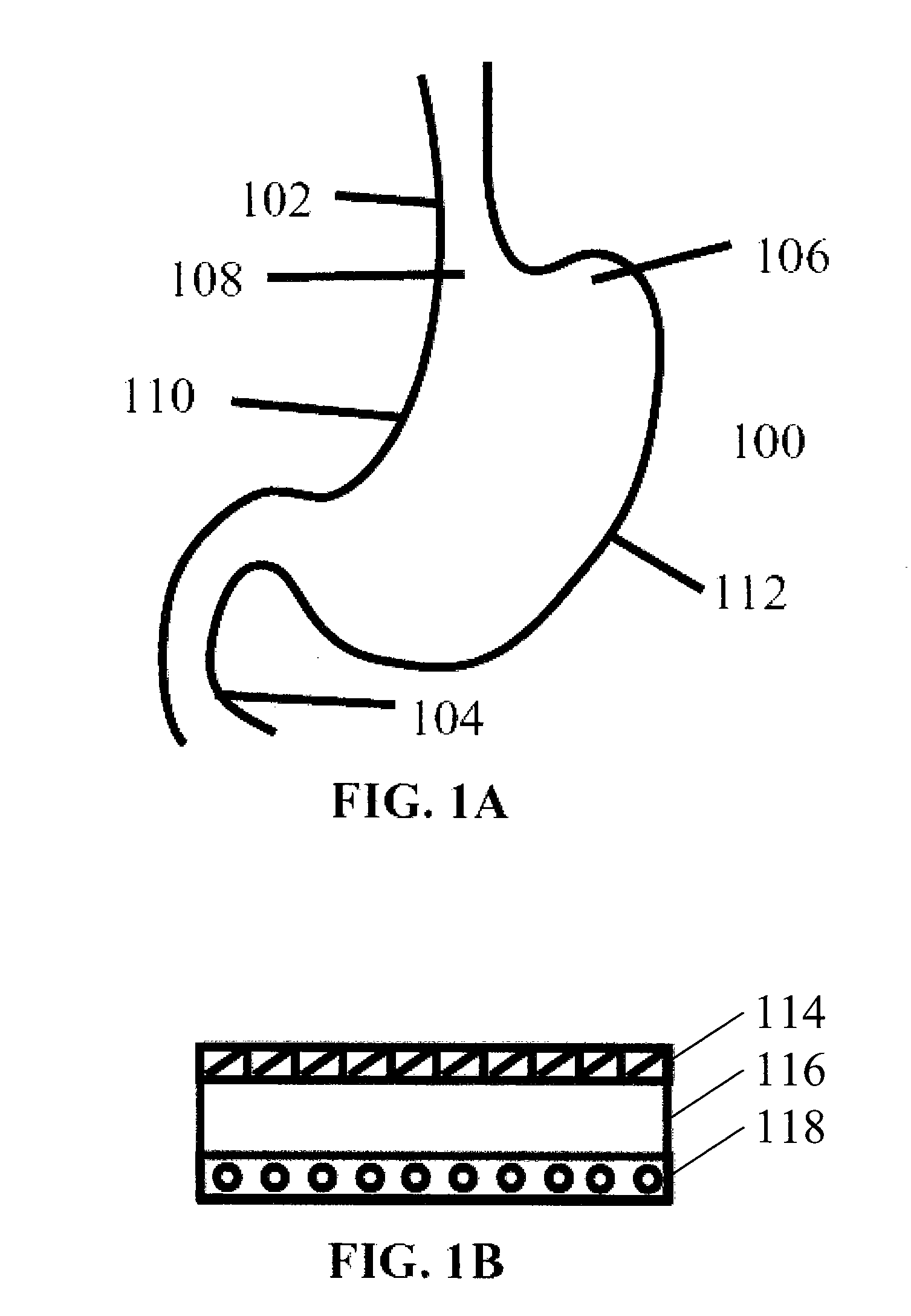 Methods and devices for treating obesity and gerd by intussuscepting a portion of stomach tissue