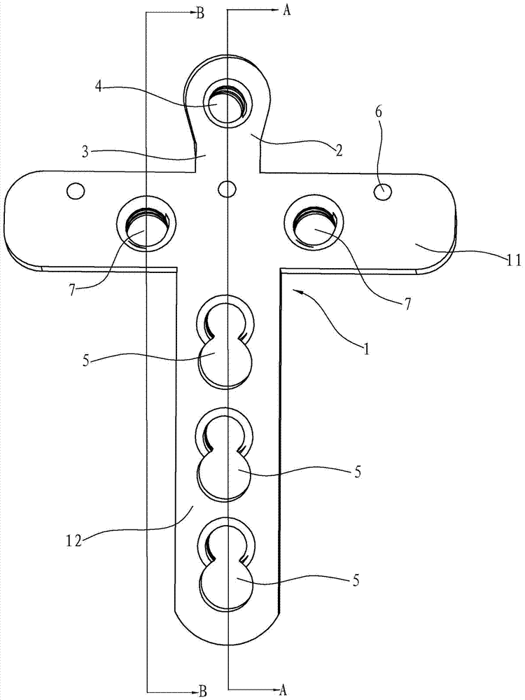 Ulnar coronoid lateral column plate