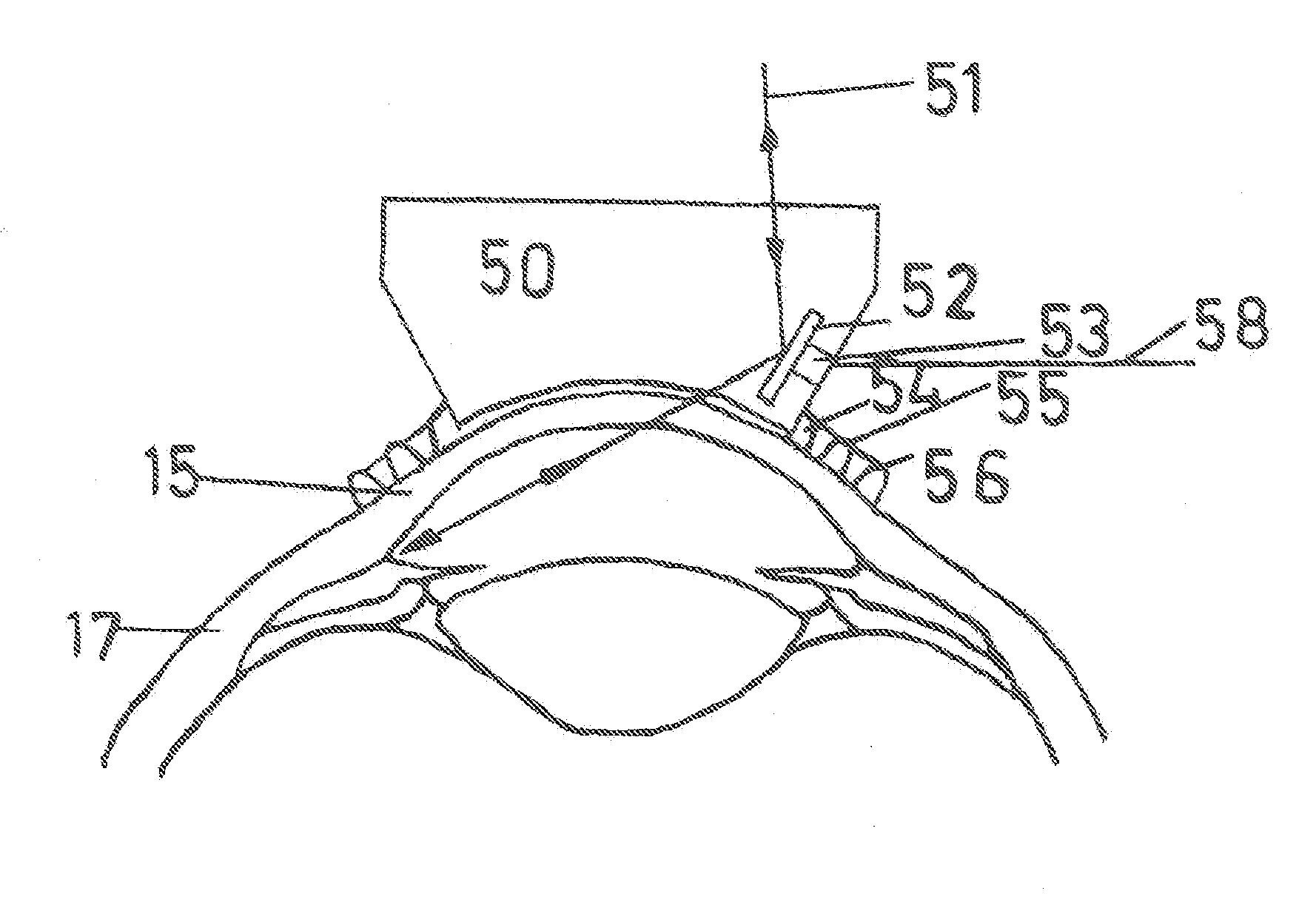 Methods and Apparatuses for the Treatment of Glaucoma using visible and infrared ultrashort laser pulses