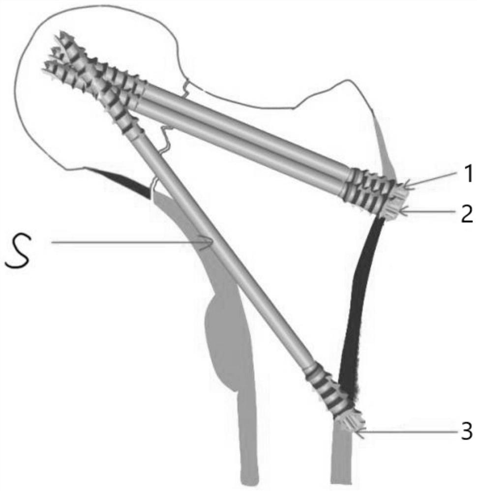 Reverse V-shaped hollow screw assembly for fixing femoral neck fracture