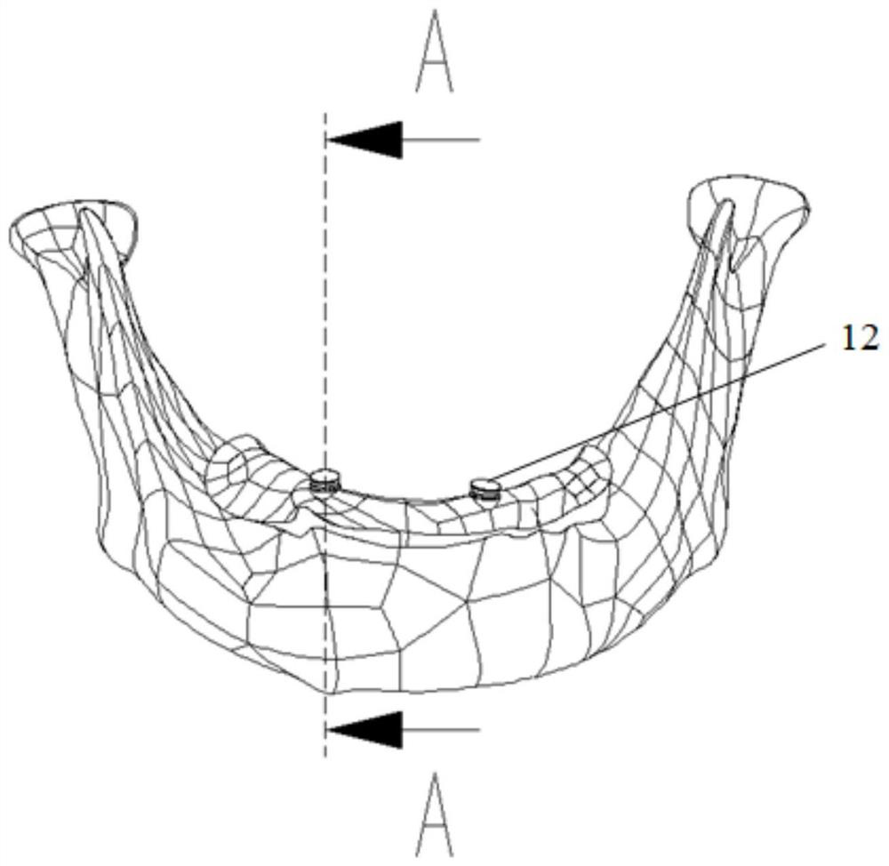 Dental implant and dental implant manufacturing method