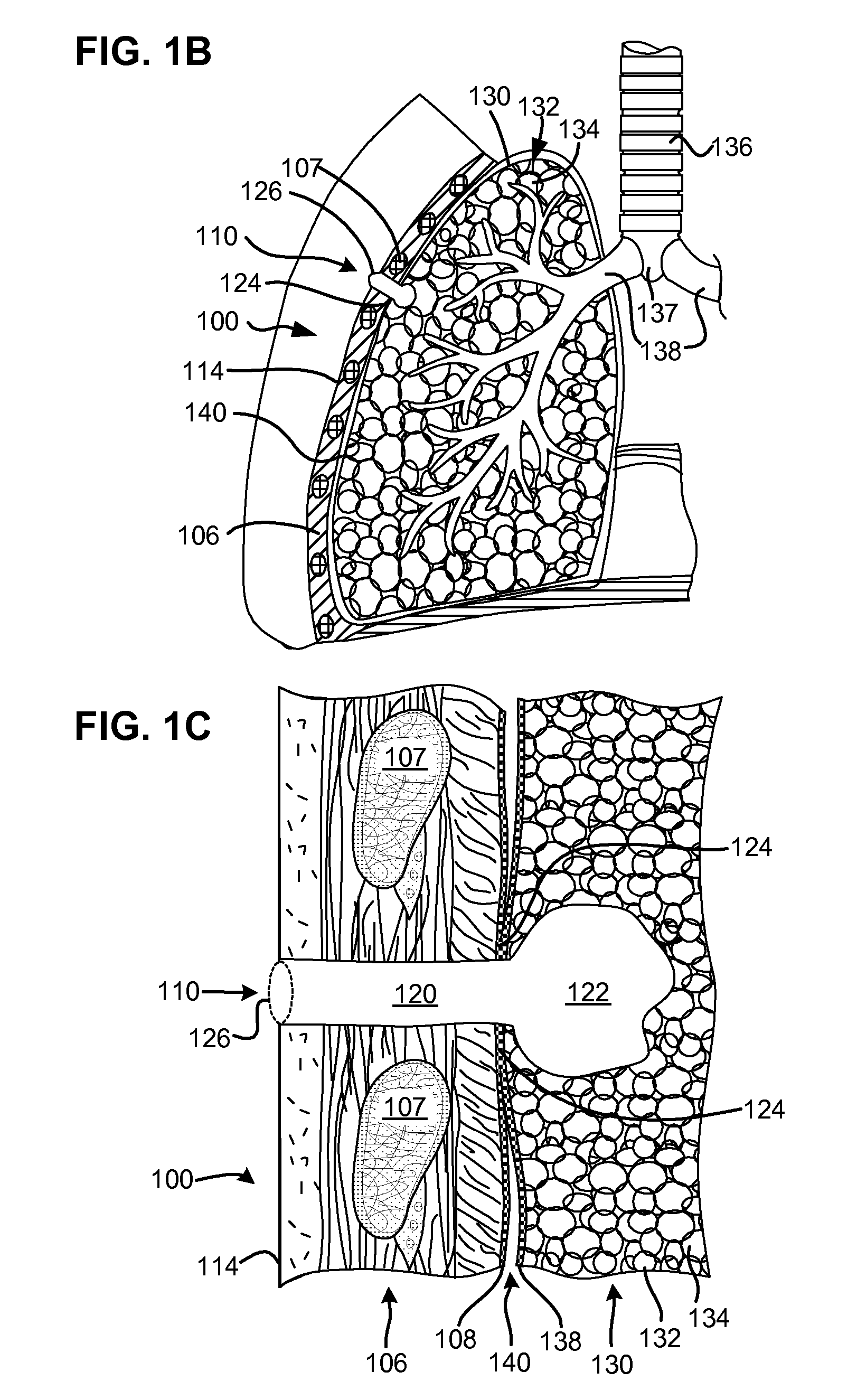 Surgical instruments for creating a pneumostoma and treating chronic obstructive pulmonary disease