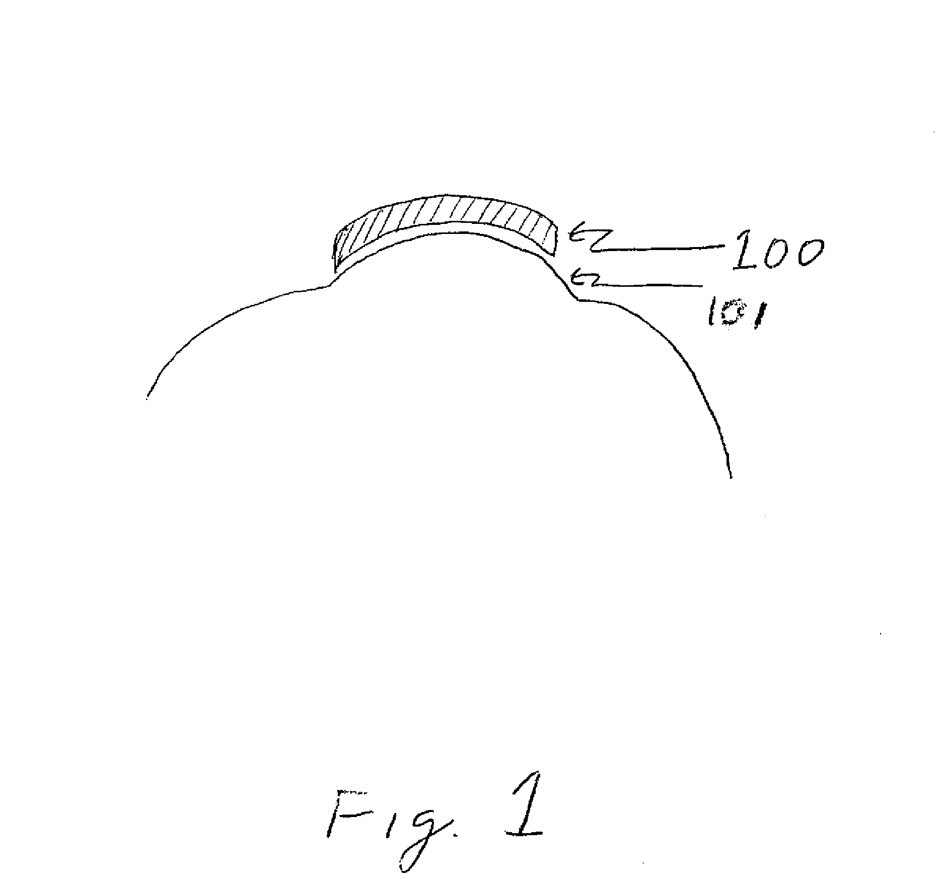 Apparatus and Method for Removing Epithelium from the Cornea