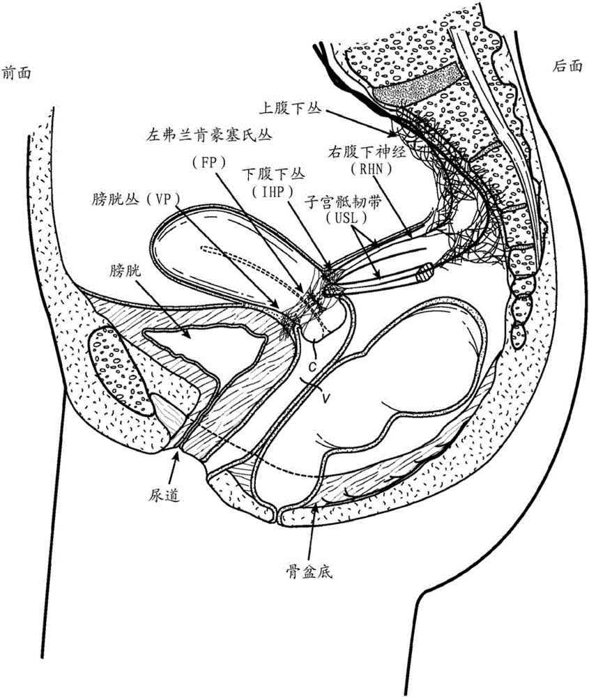 Devices and methods for stimulating nerves