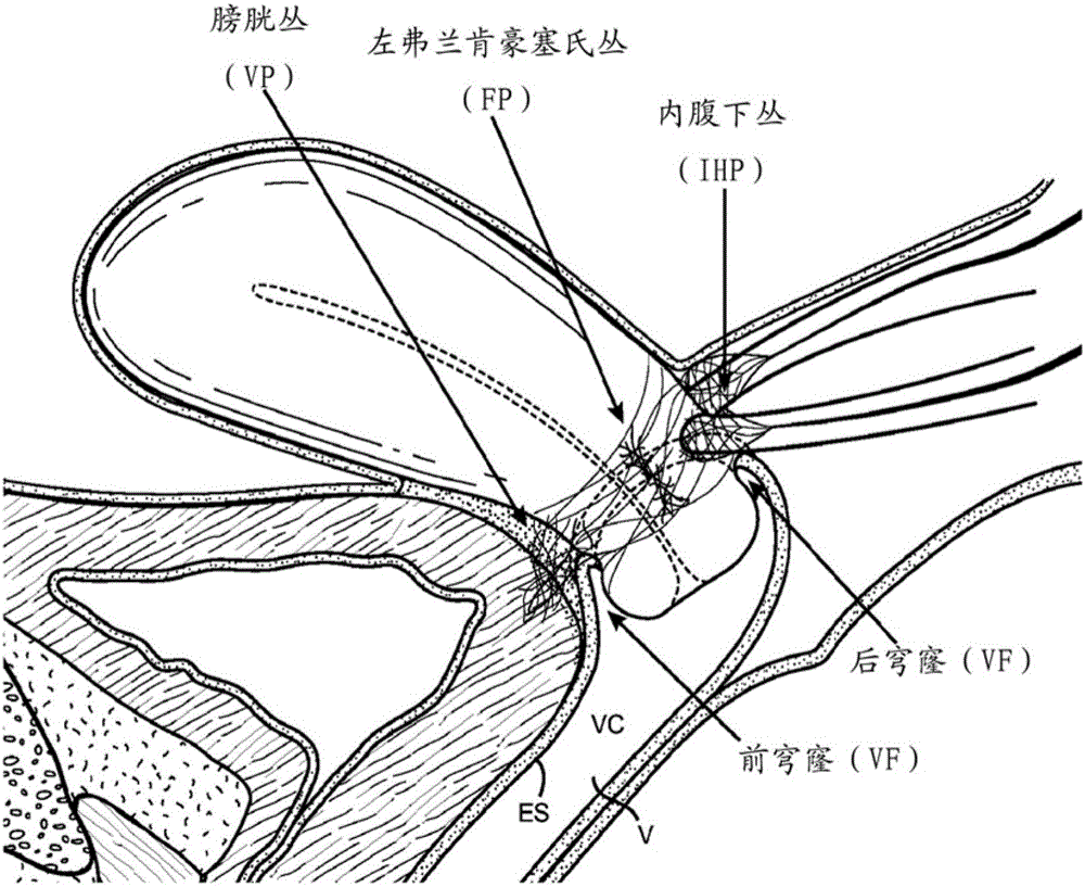 Devices and methods for stimulating nerves