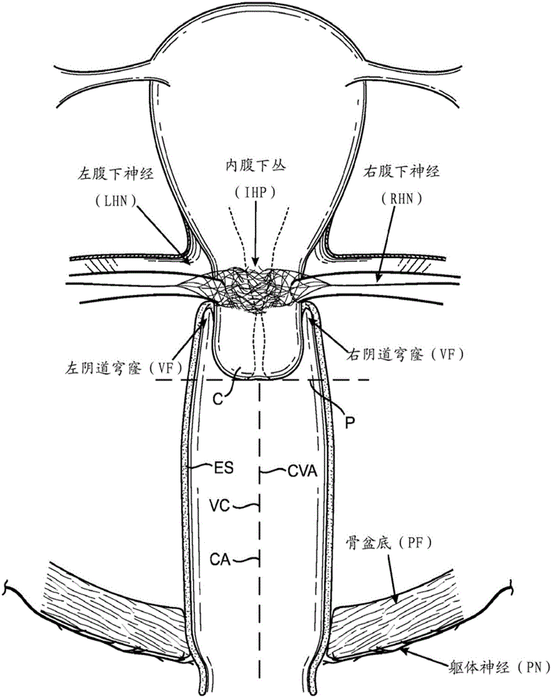 Devices and methods for stimulating nerves