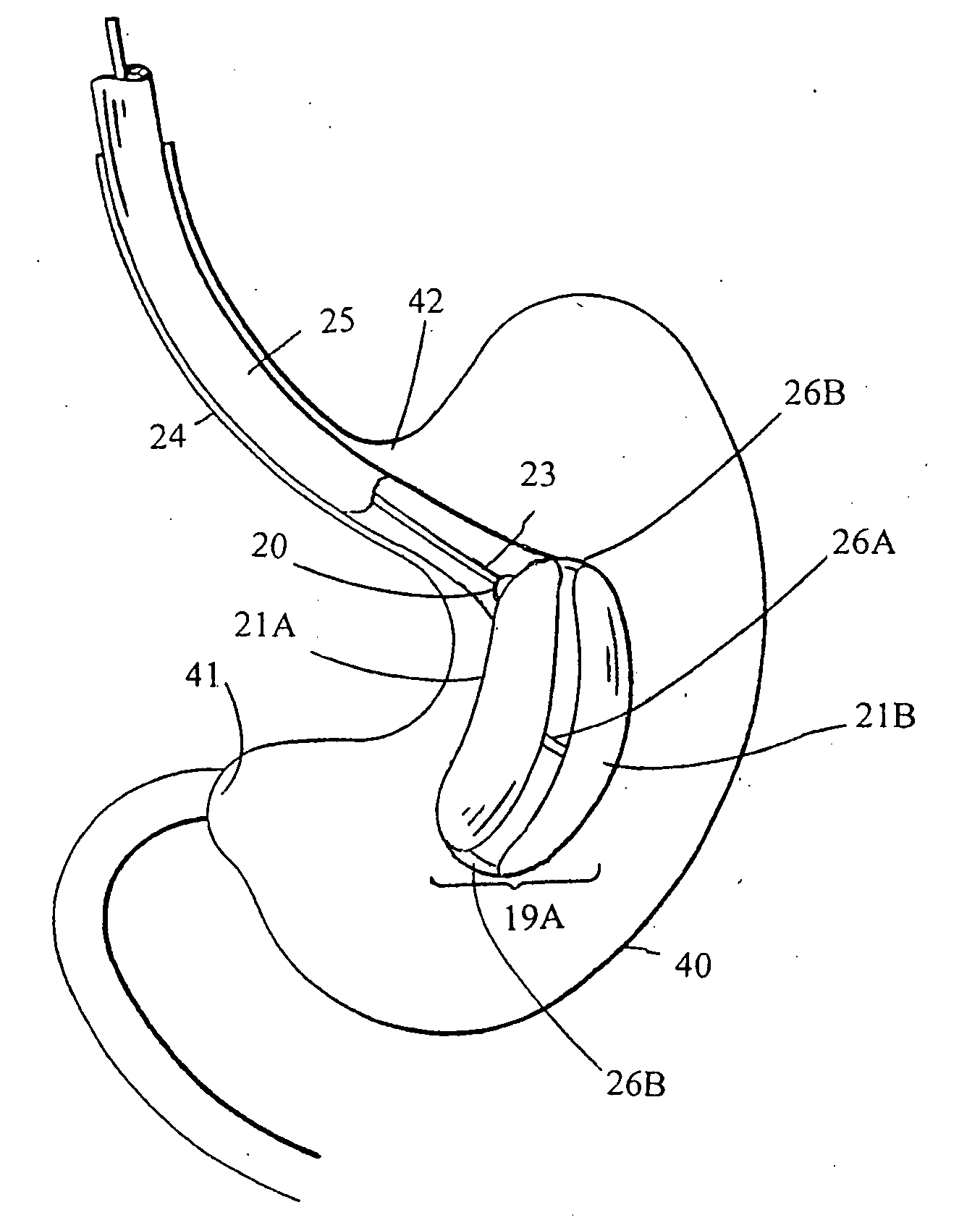 Intragastric space filler and methods of manufacture
