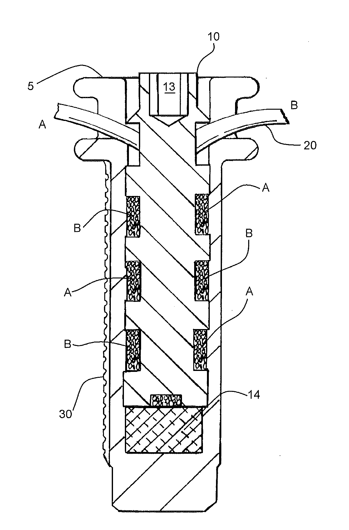 Internal Joint Bracing System and Suture Anchoring Assembly Therefore