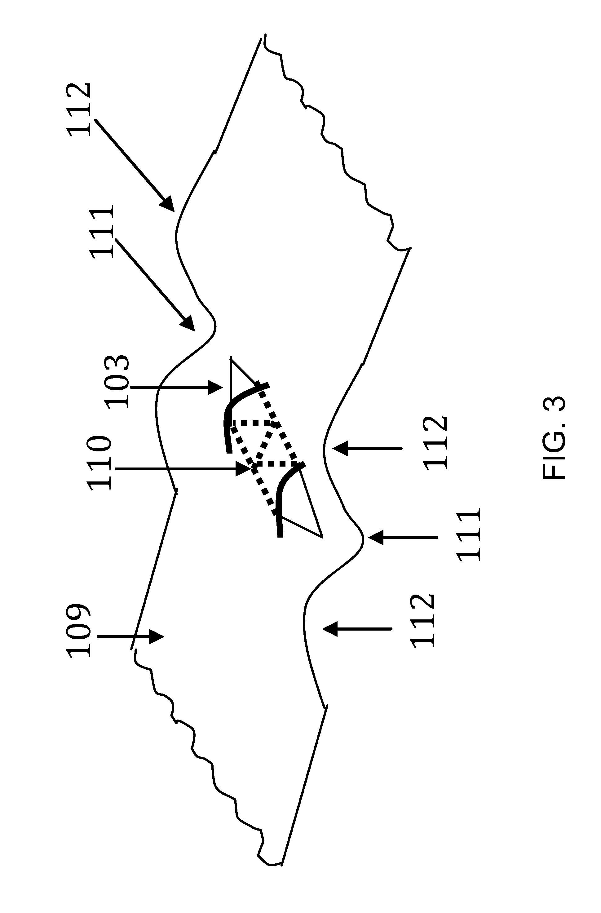 Device and method for treatment of retinal detachment and other maladies of the eye