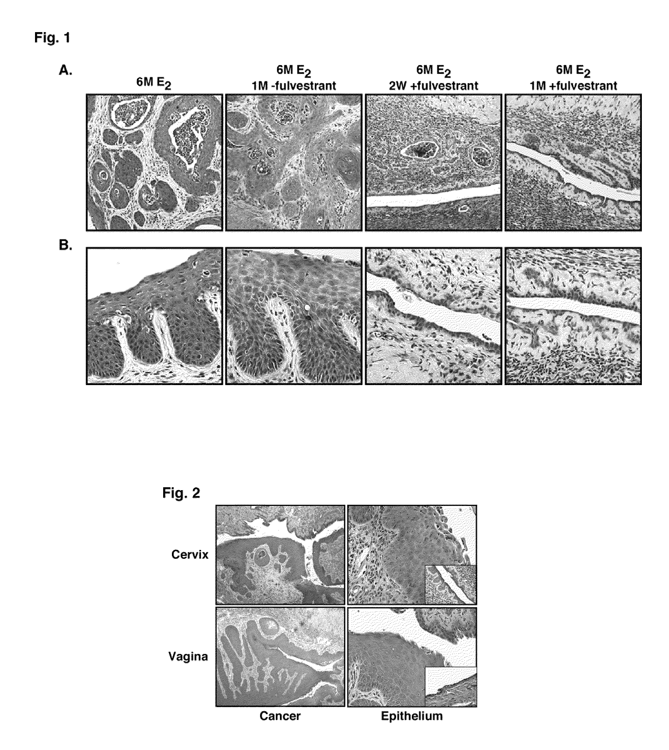 Therapeutic treatment of cancer and dysplasia of the cervix or vagina using estrogen antagonists