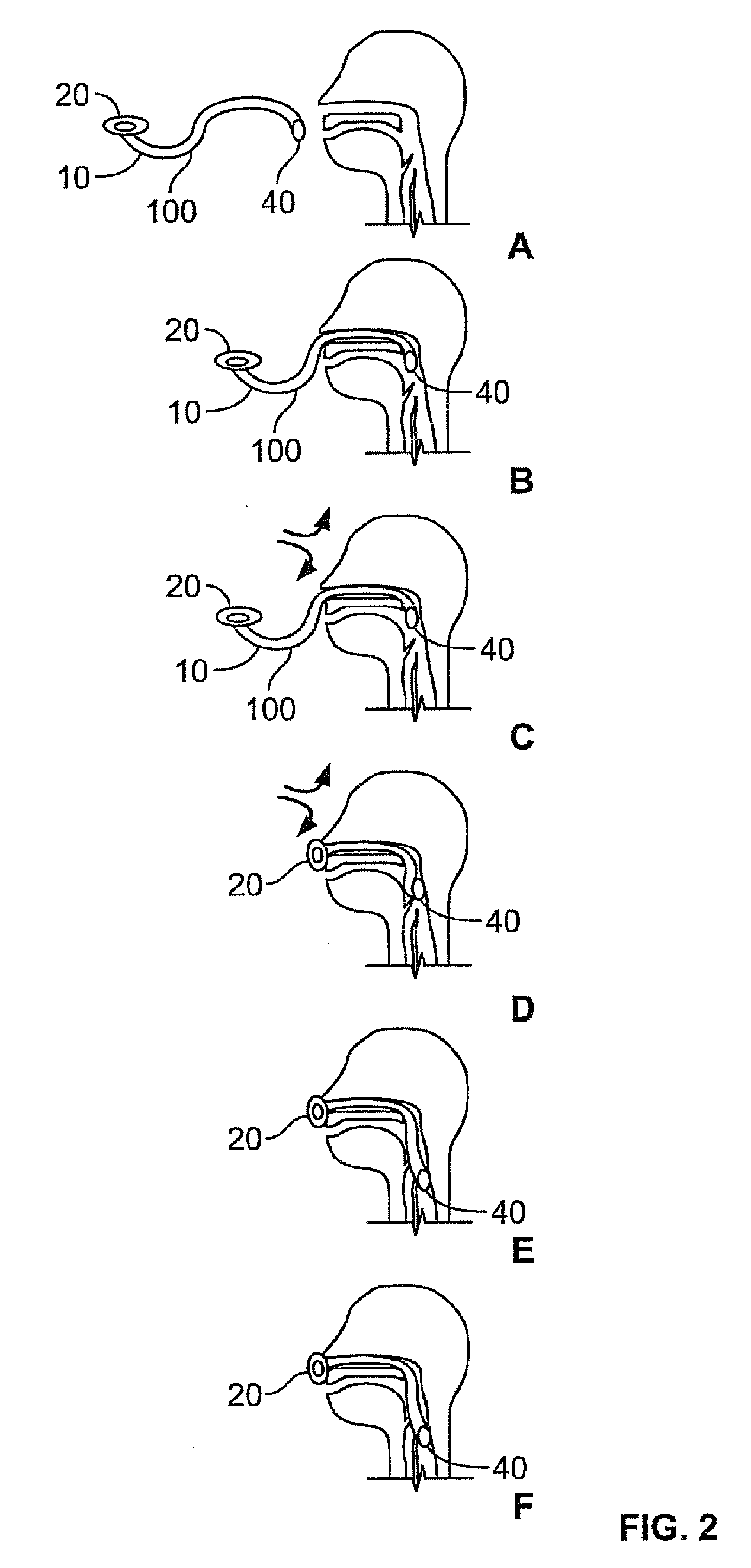 Devices and methods for nasoenteric intubation