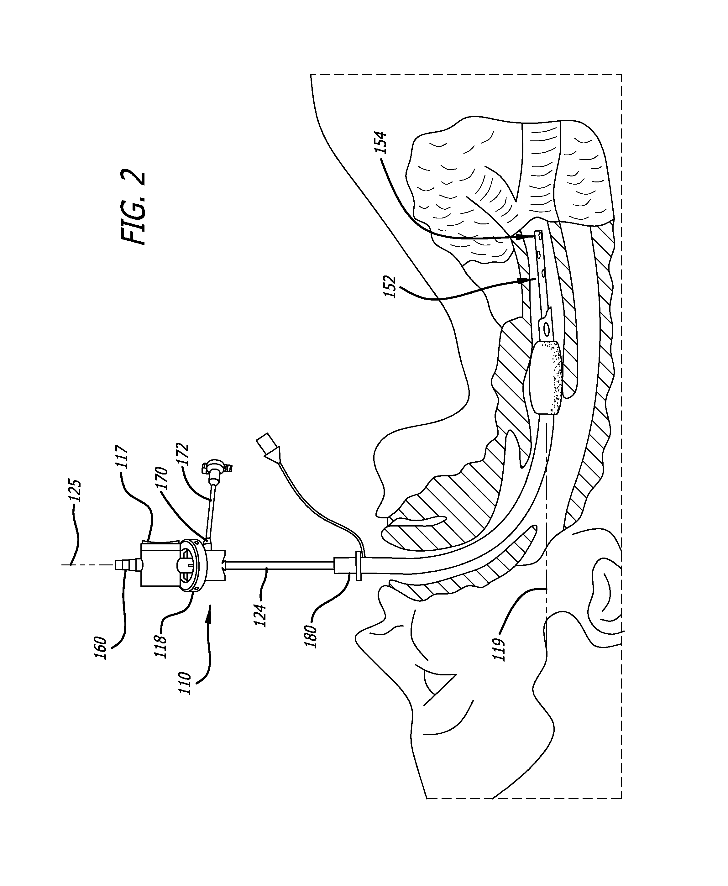 Bi-lateral endobronchial suctioning device and medical suctioning system for intubated patients