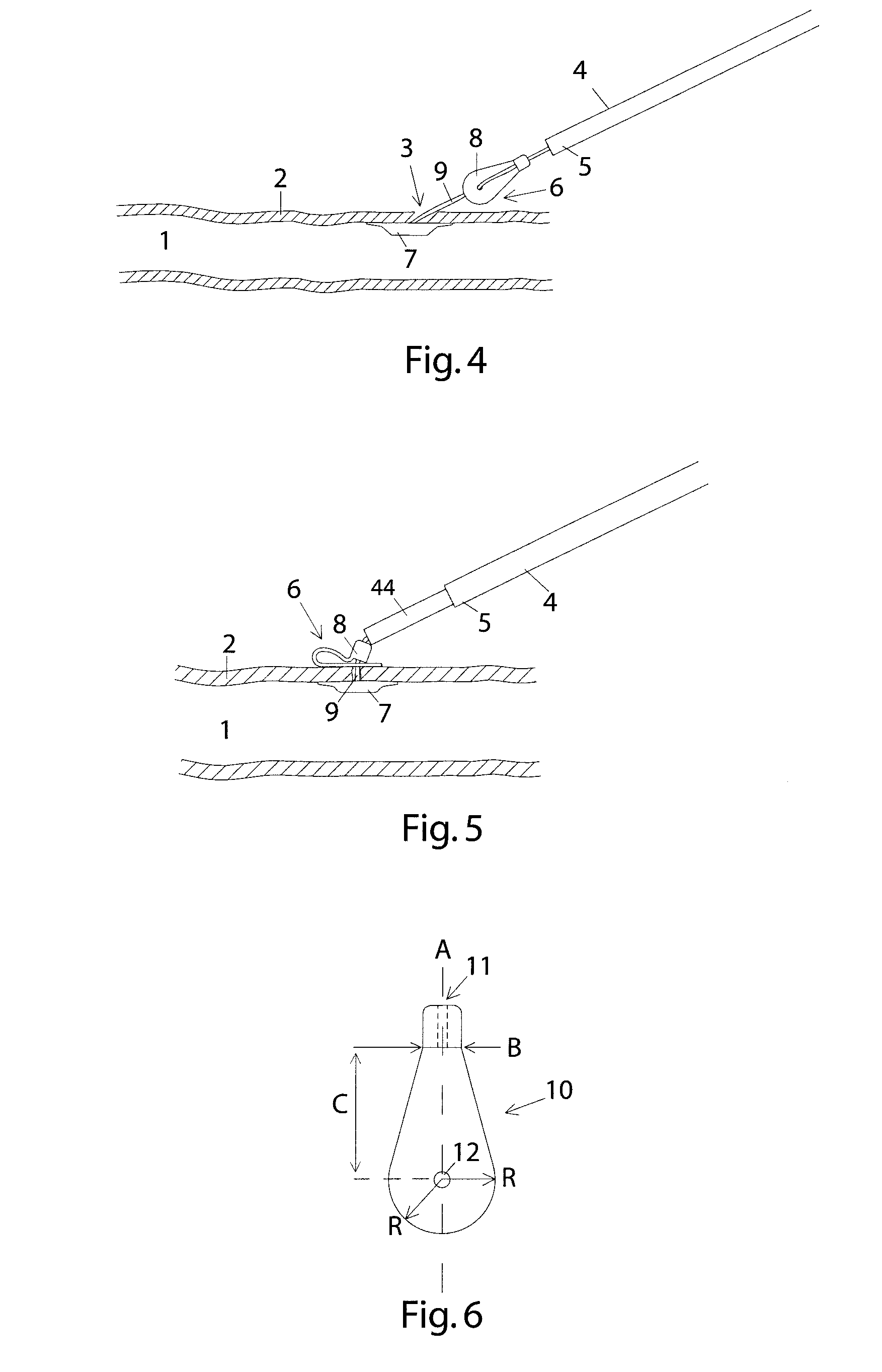 Method and device for sealing a puncture hole in a bodily organ