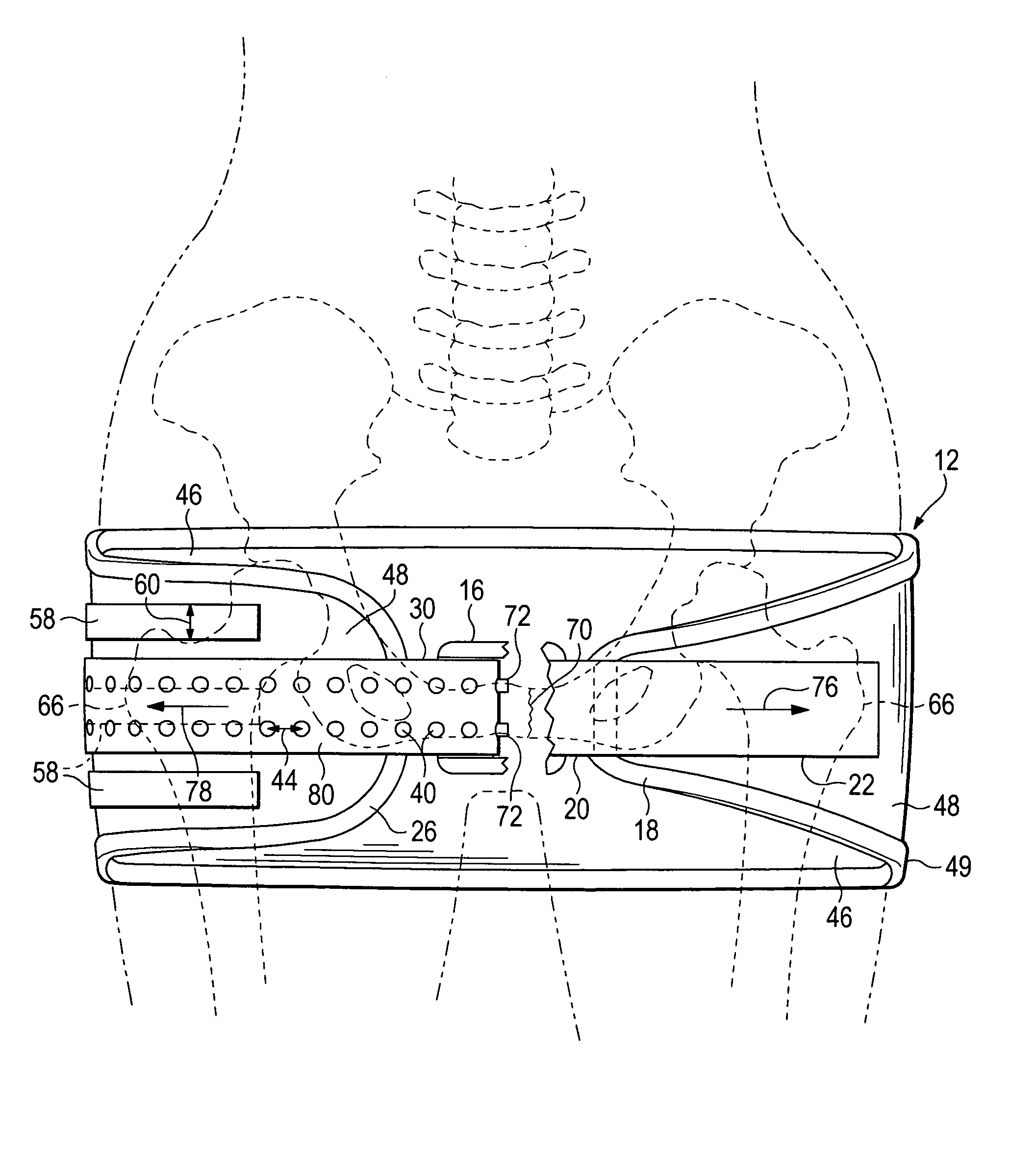 Emergency stabilization of a fractured pelvis