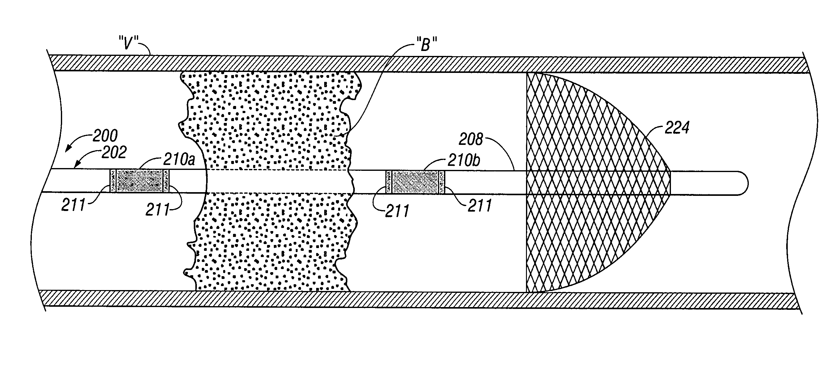Percutaneous or surgical radiofrequency intravascular thrombectomy catheter system and method