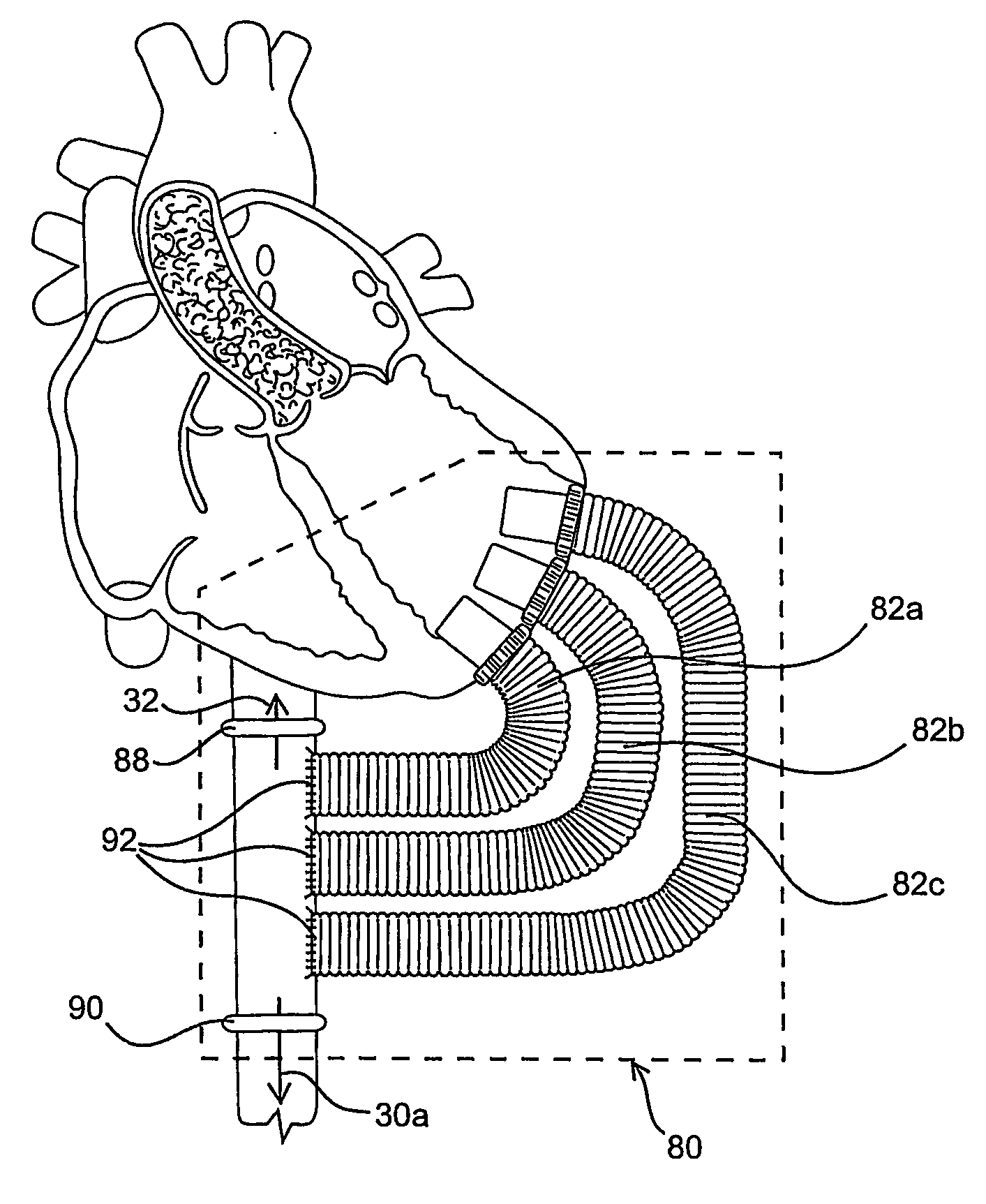 Methods and devices for improving cardiac output