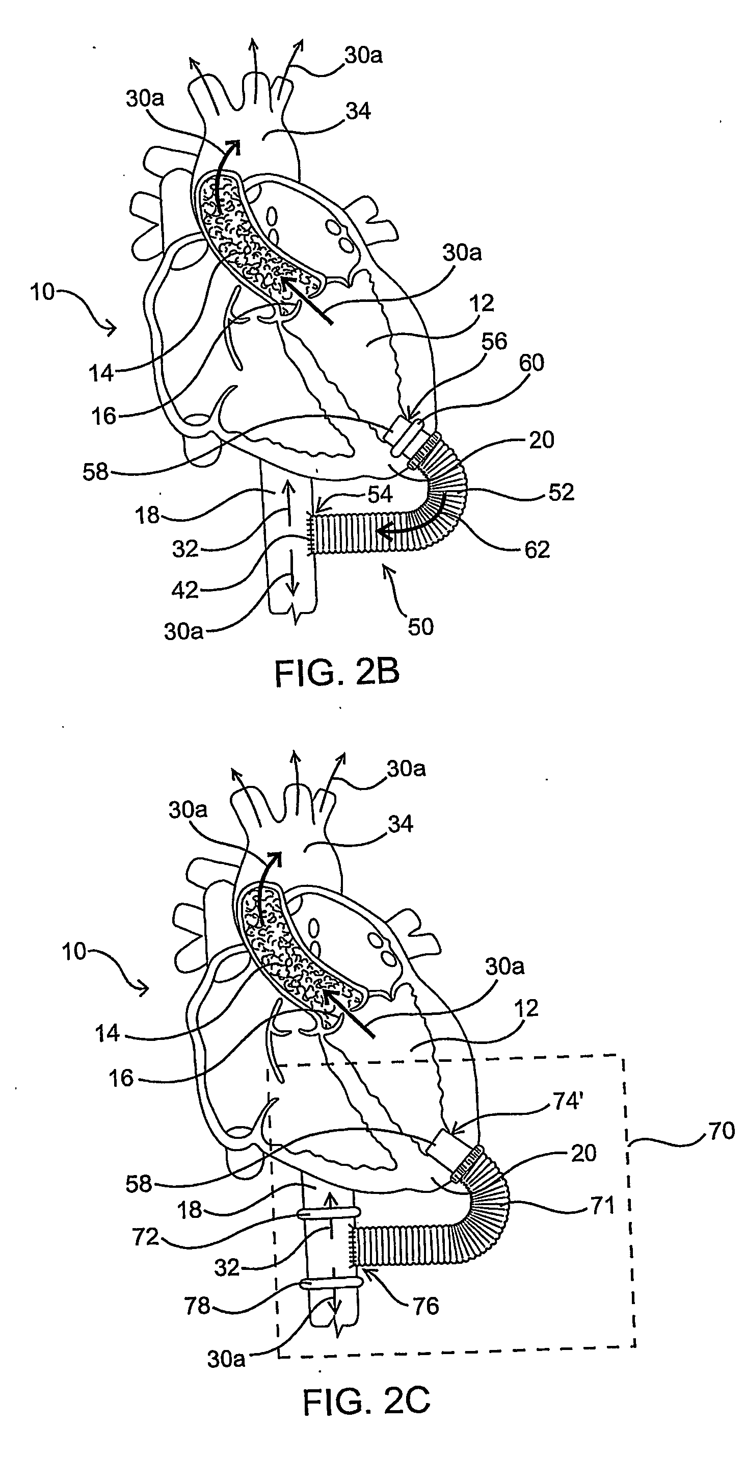 Methods and devices for improving cardiac output