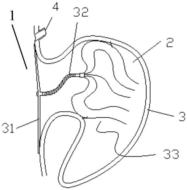 Left auricle occluder