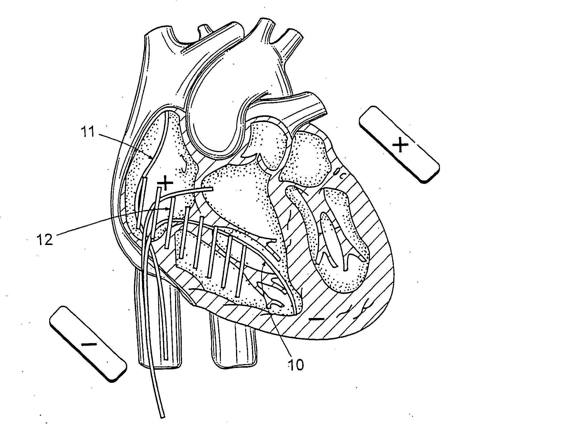 Apparatus and method for cardioversion