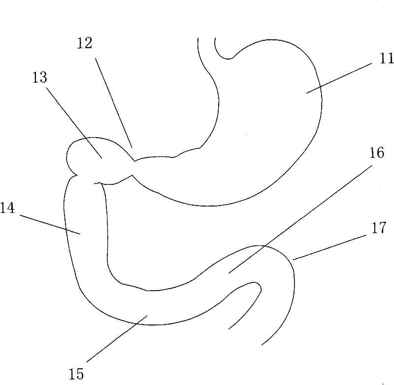 Duodenal sleeve and conveyor thereof