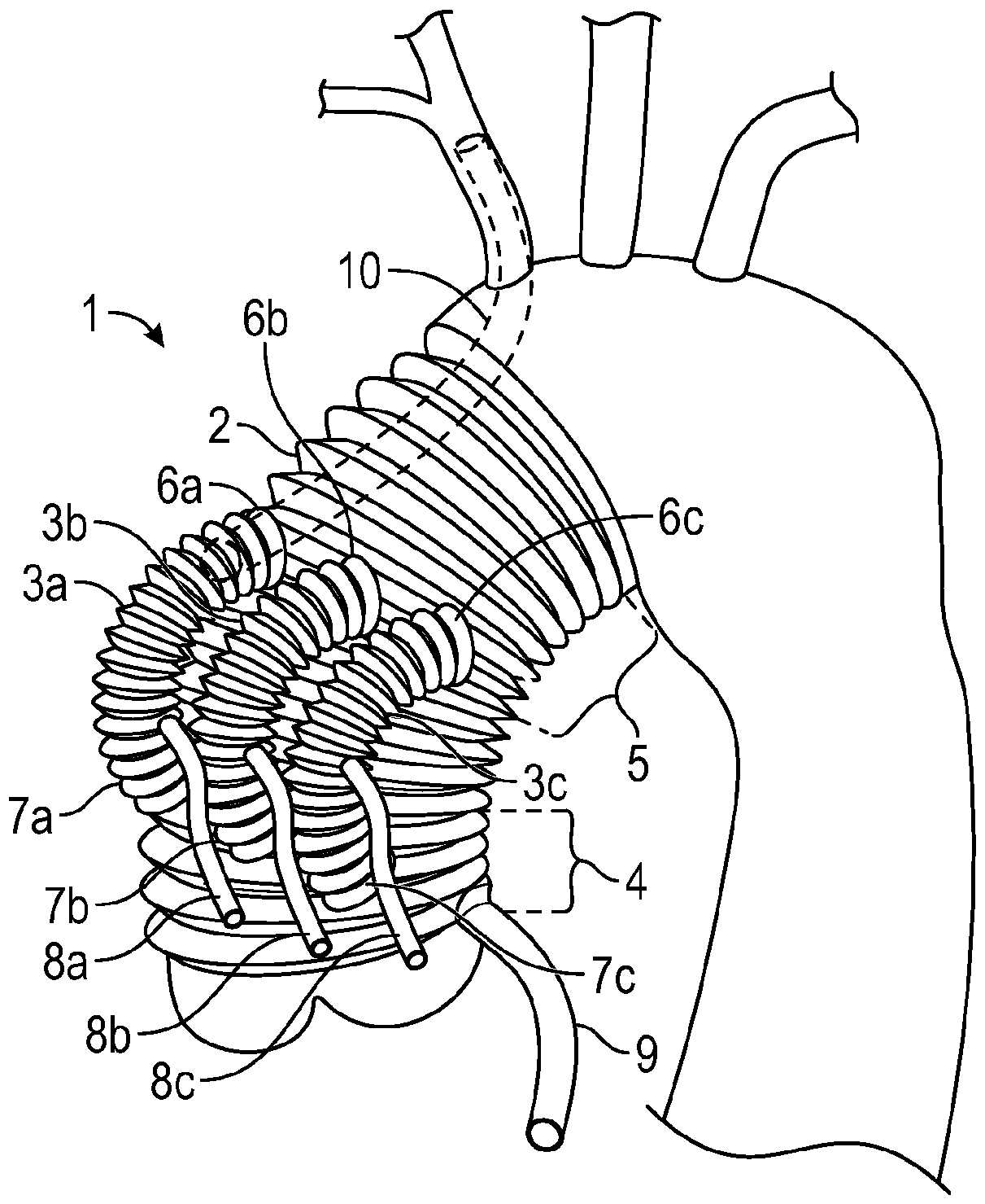 Systems and methods for treatment of aortic dissection