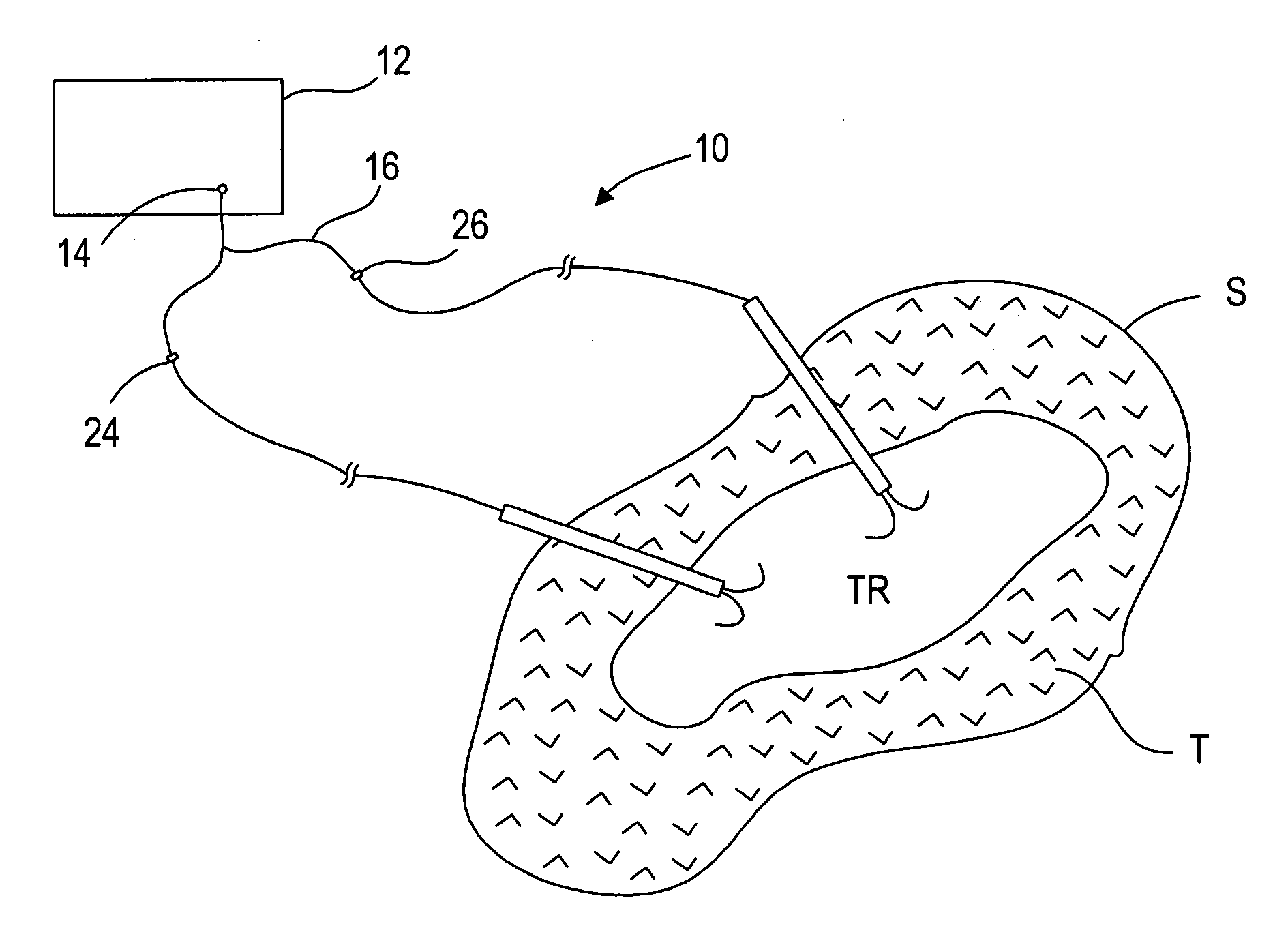 Systems and methods for performing simultaneous ablation