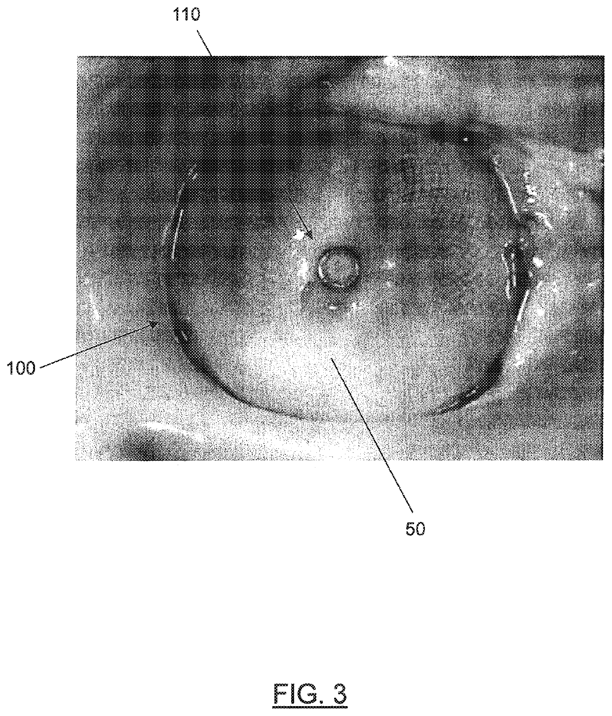 Percutaneous catheter directed intravascular occlusion devices with retractable stabilizing wires