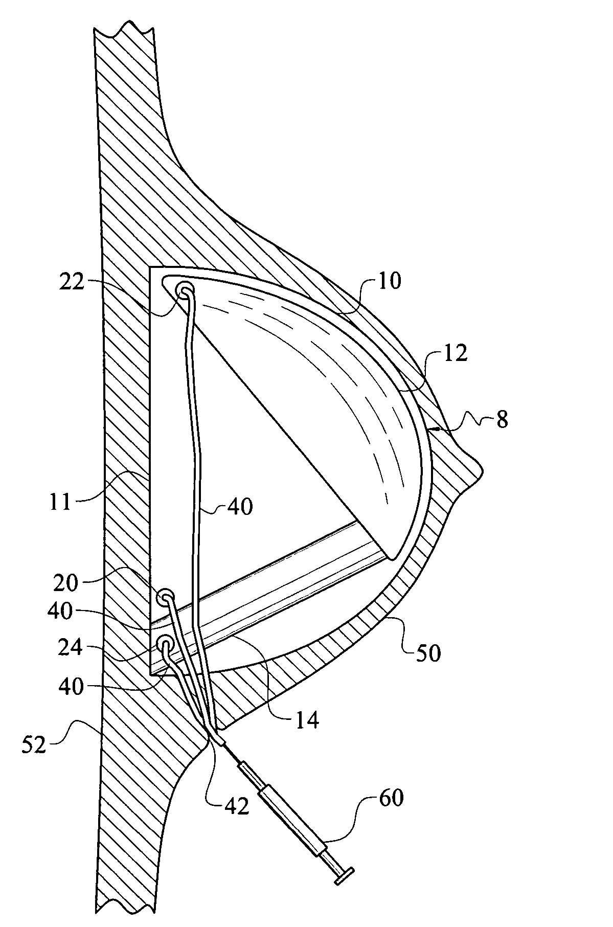 Method and apparatus for reconstructive surgery
