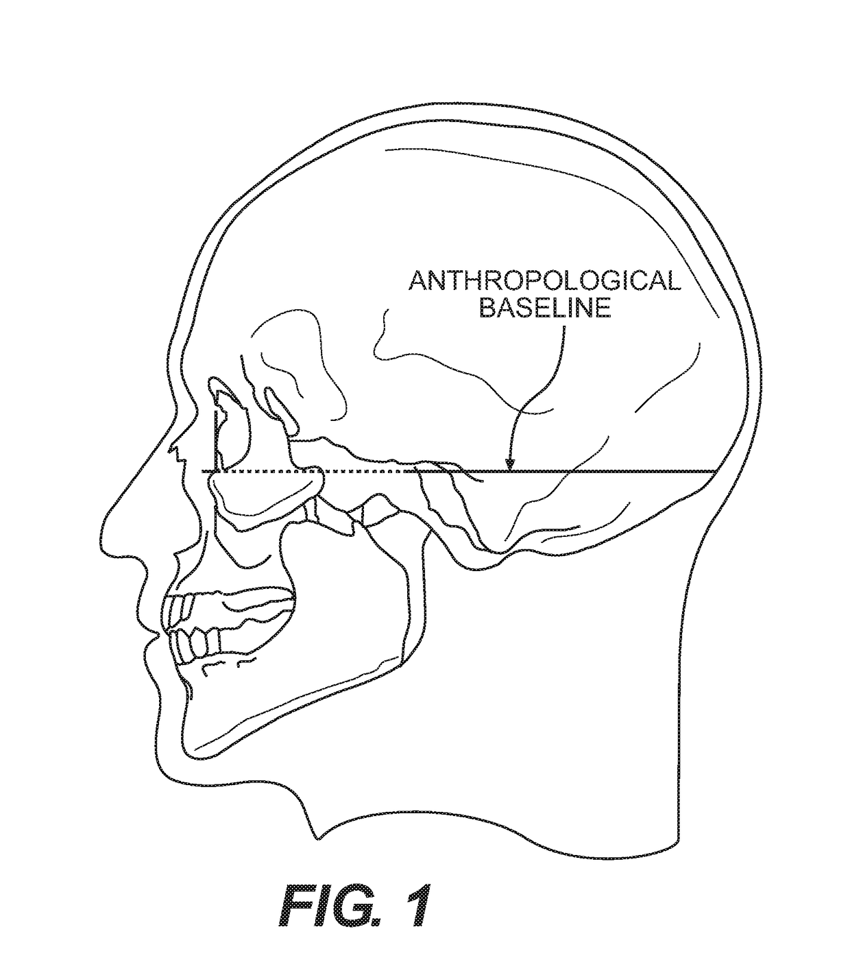 Method for performing stereotactic brain surgery using 3D geometric modeling