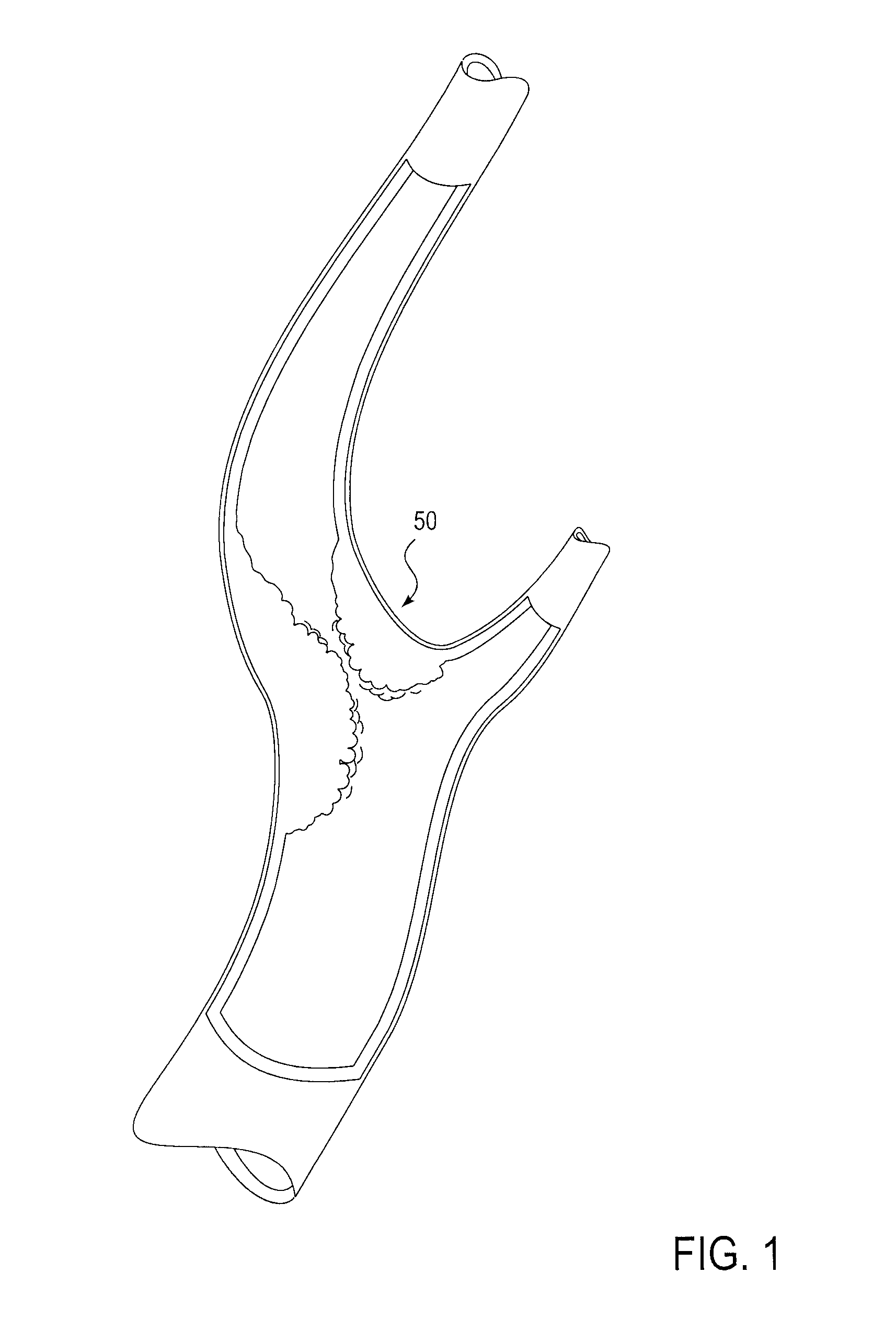 Catheter system for protected angioplasty and stenting at a carotid bifurcation