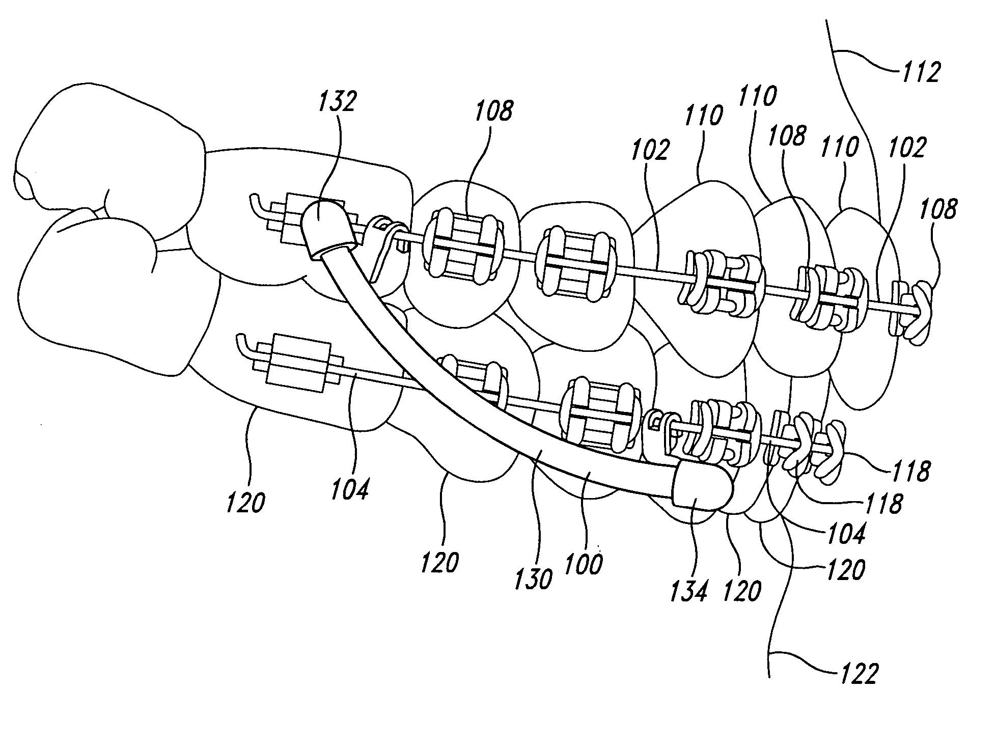 Orthodontic device for attachment to orthodontic wire