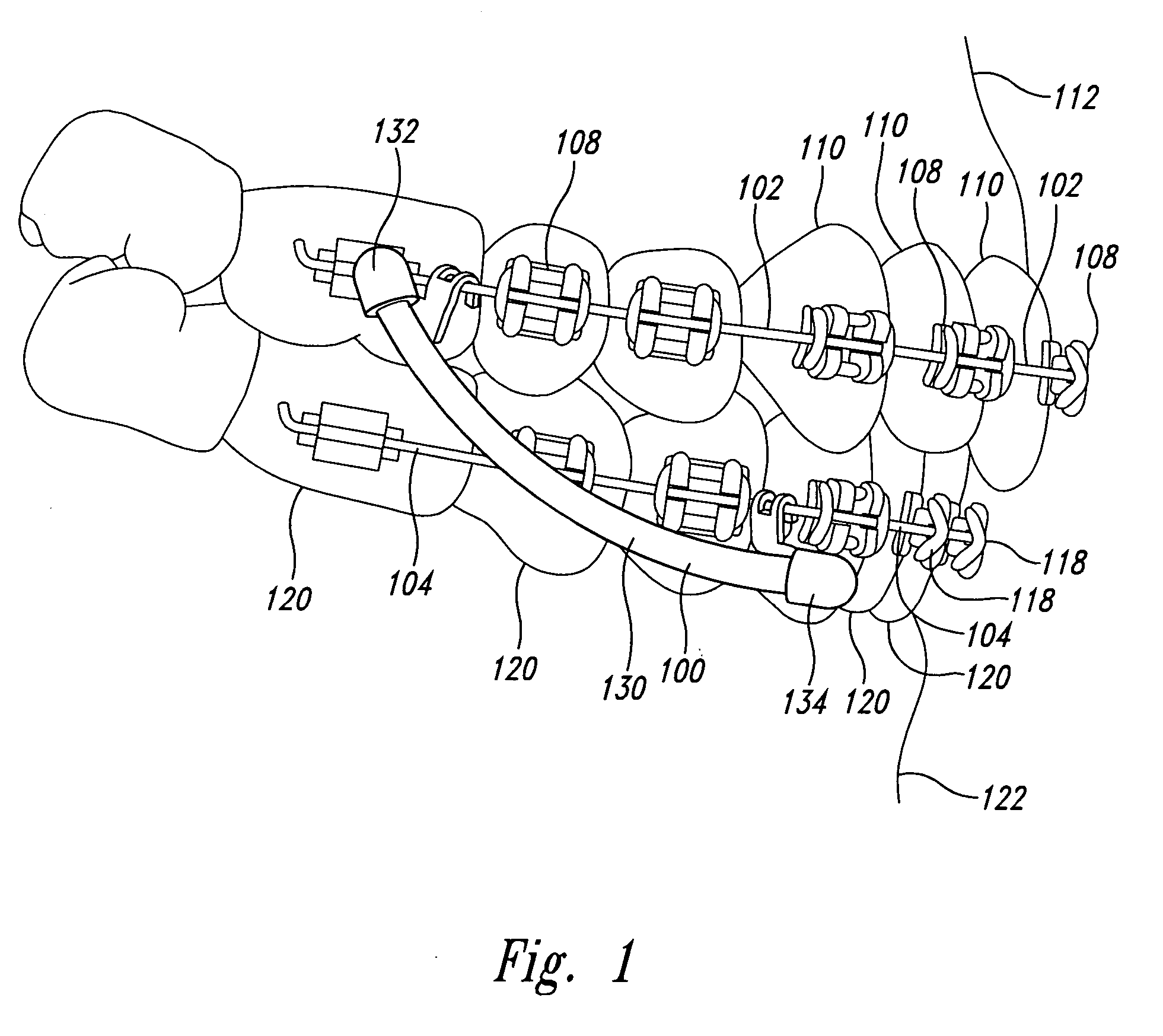 Orthodontic device for attachment to orthodontic wire