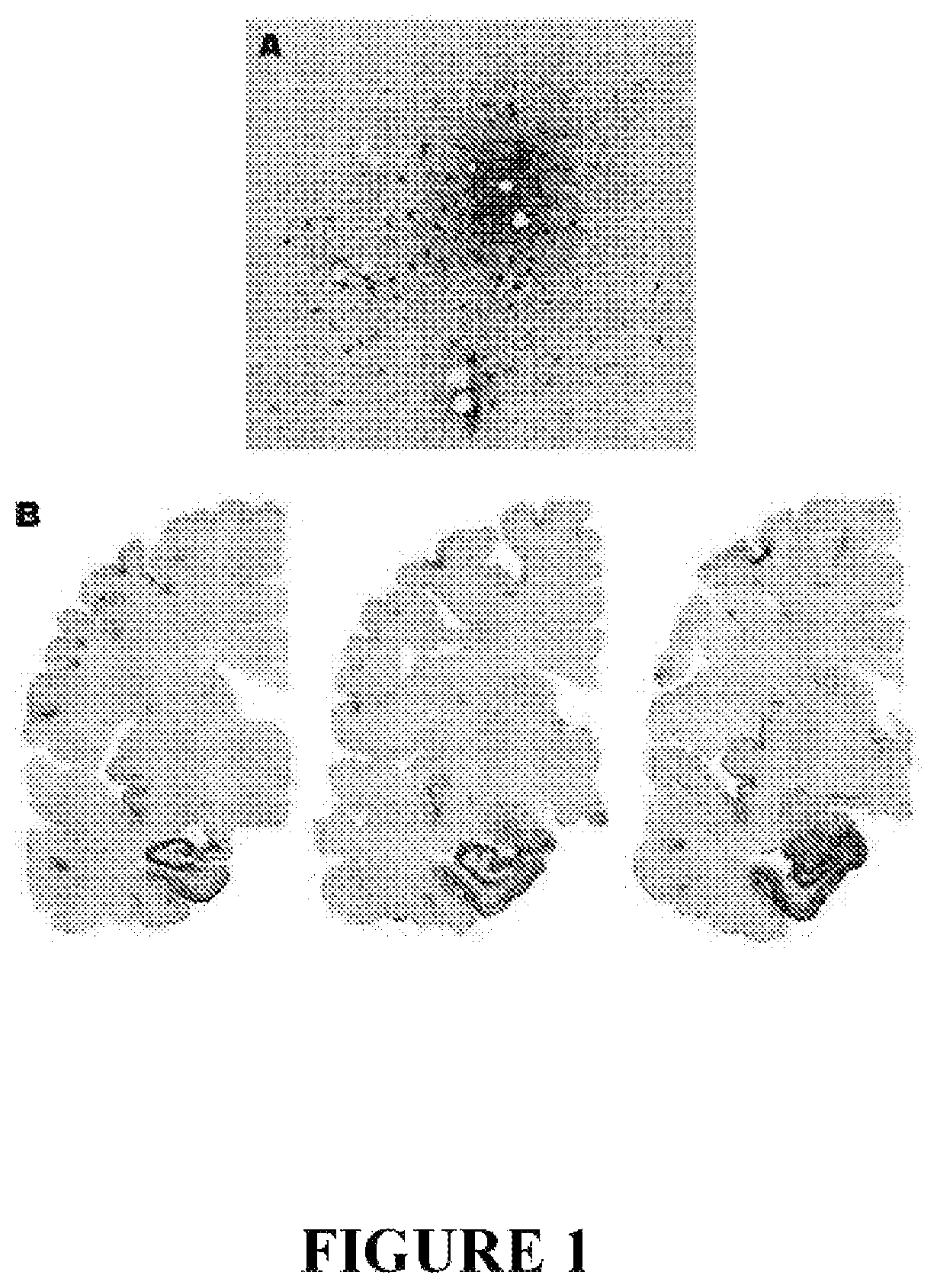 Method for preventing and/or treating chronic traumatic encephalopathy-I