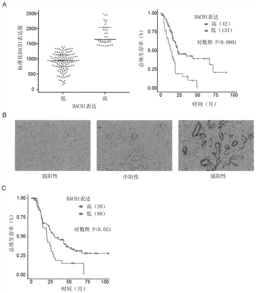 Novel marker of epithelial-mesenchymal transition in pancreatic cancer