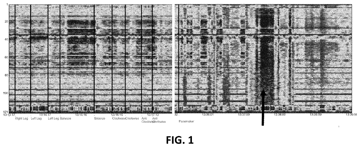 Systems and Methods for Cooperative Invasive and Noninvasive Brain Stimulation