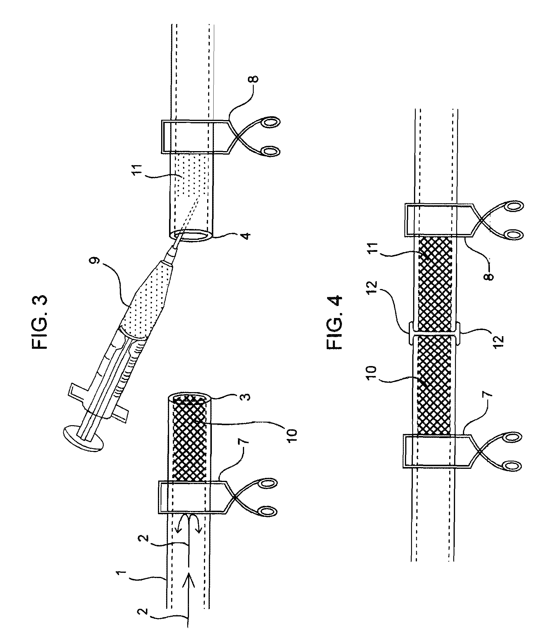 Compositions and methods for joining non-conjoined lumens