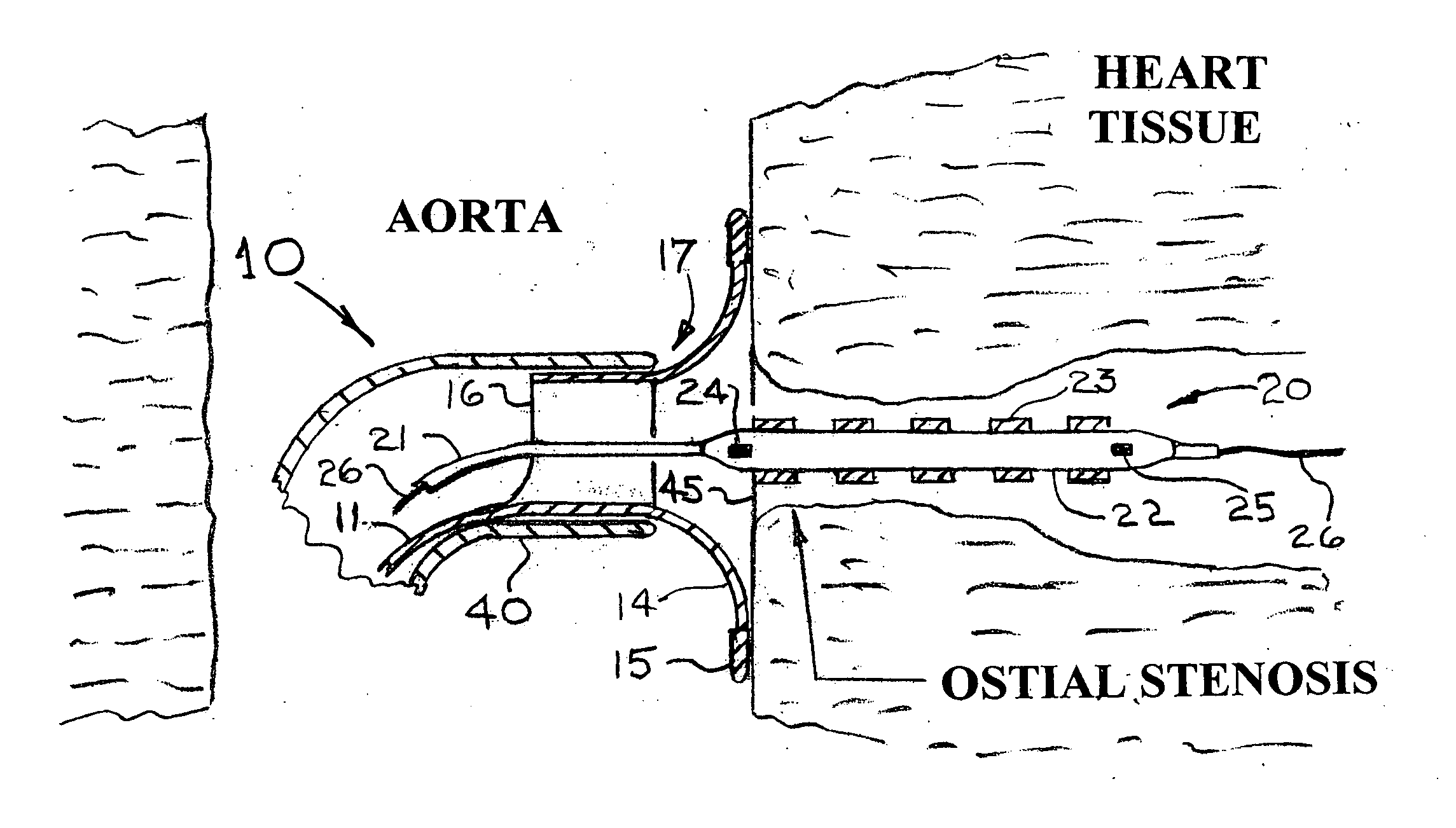 Device and method for placing a stent at the ostium of a blood vessel