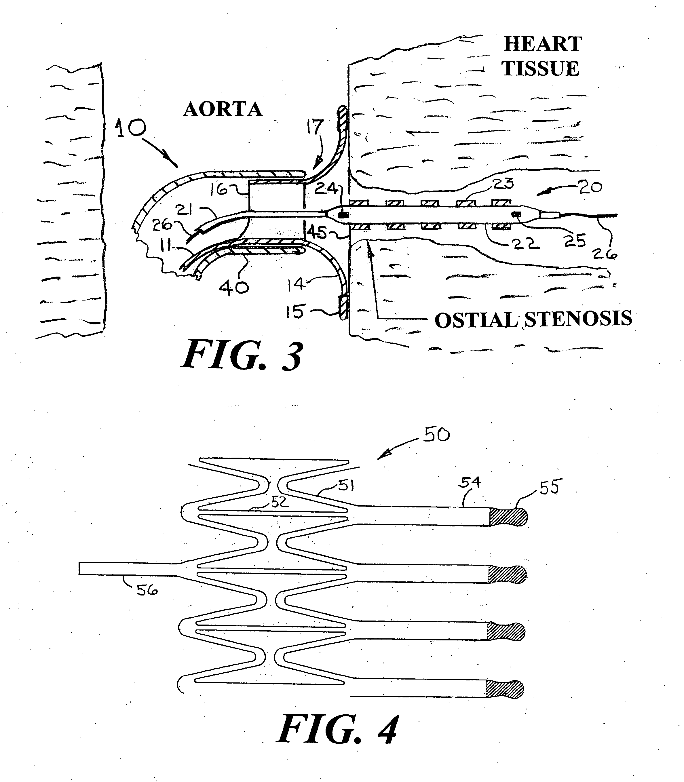 Device and method for placing a stent at the ostium of a blood vessel