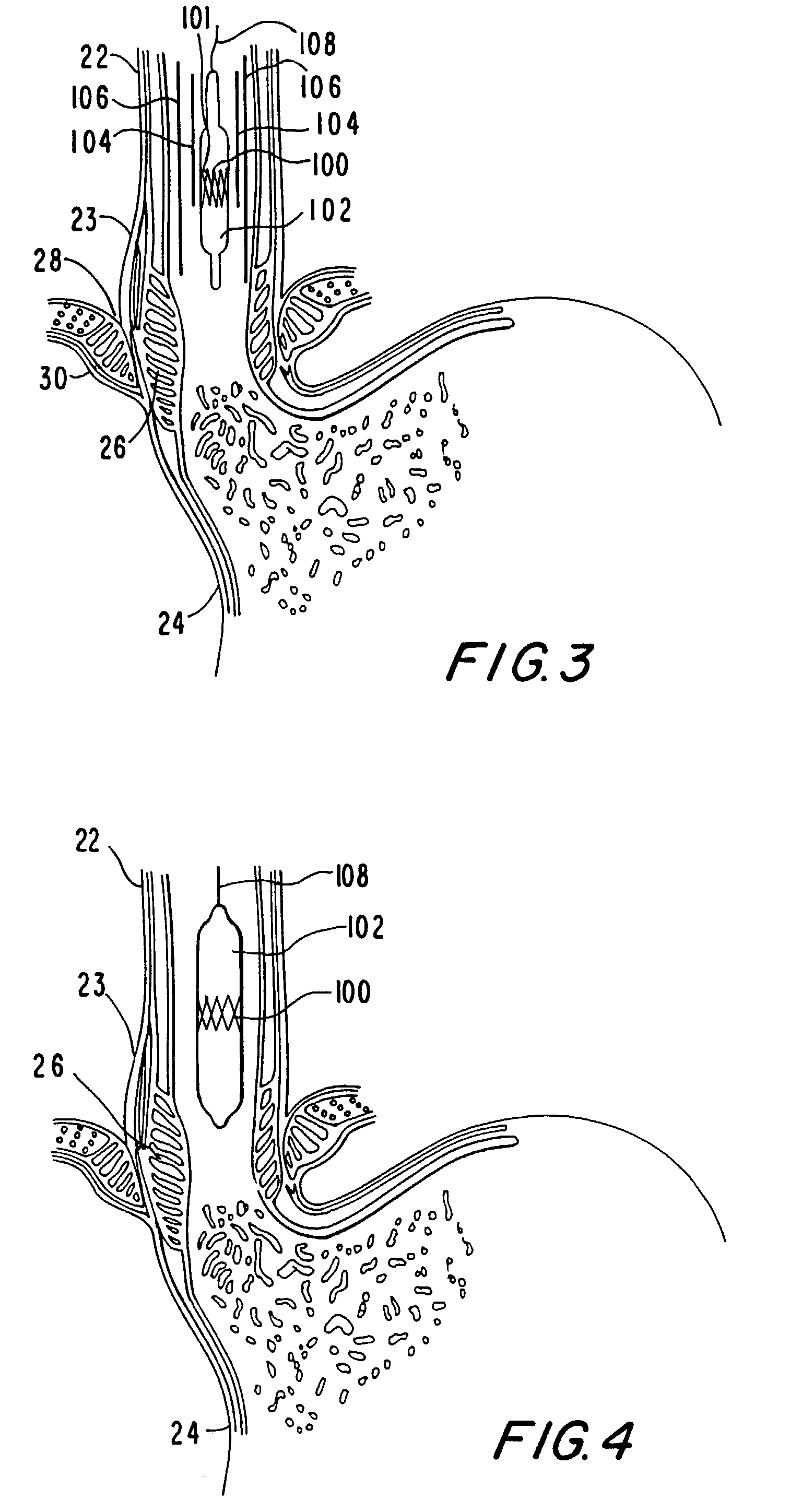 Methods and apparatus for regulating the flow of matter through body tubing