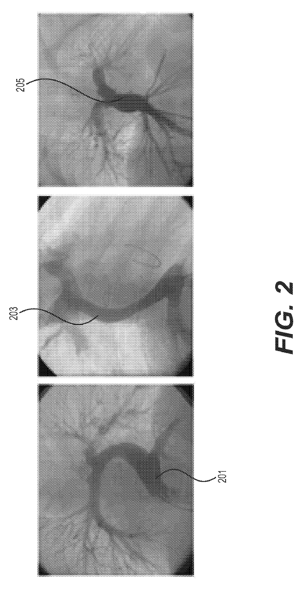 Patient-specific tissue engineered vascular graft utilizing electrospinning