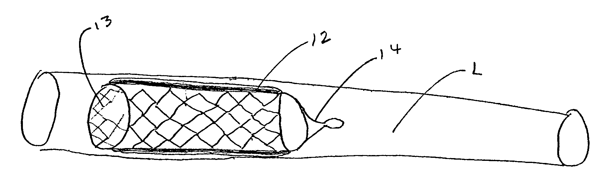 Implantable systems and stents containing cells for therapeutic uses