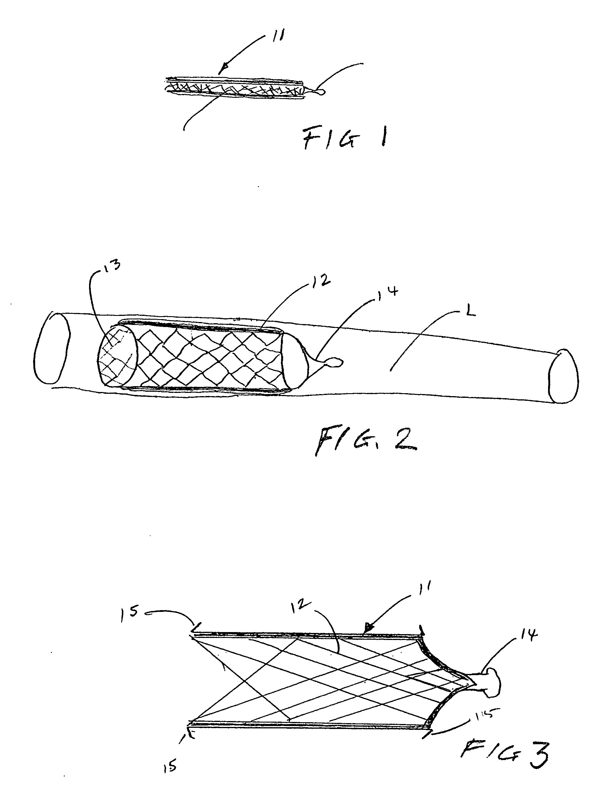 Implantable systems and stents containing cells for therapeutic uses