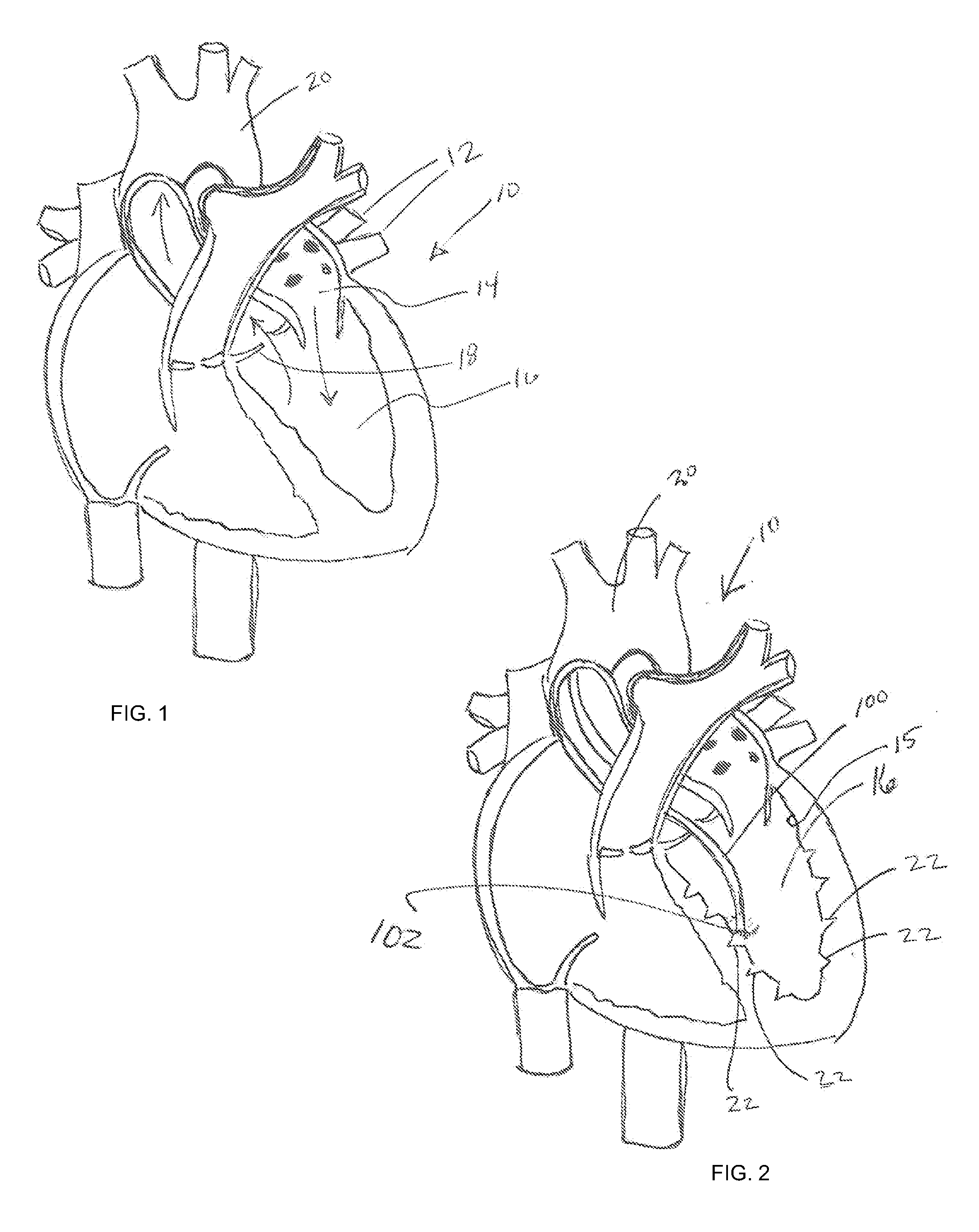 Methods and devices for diastolic assist