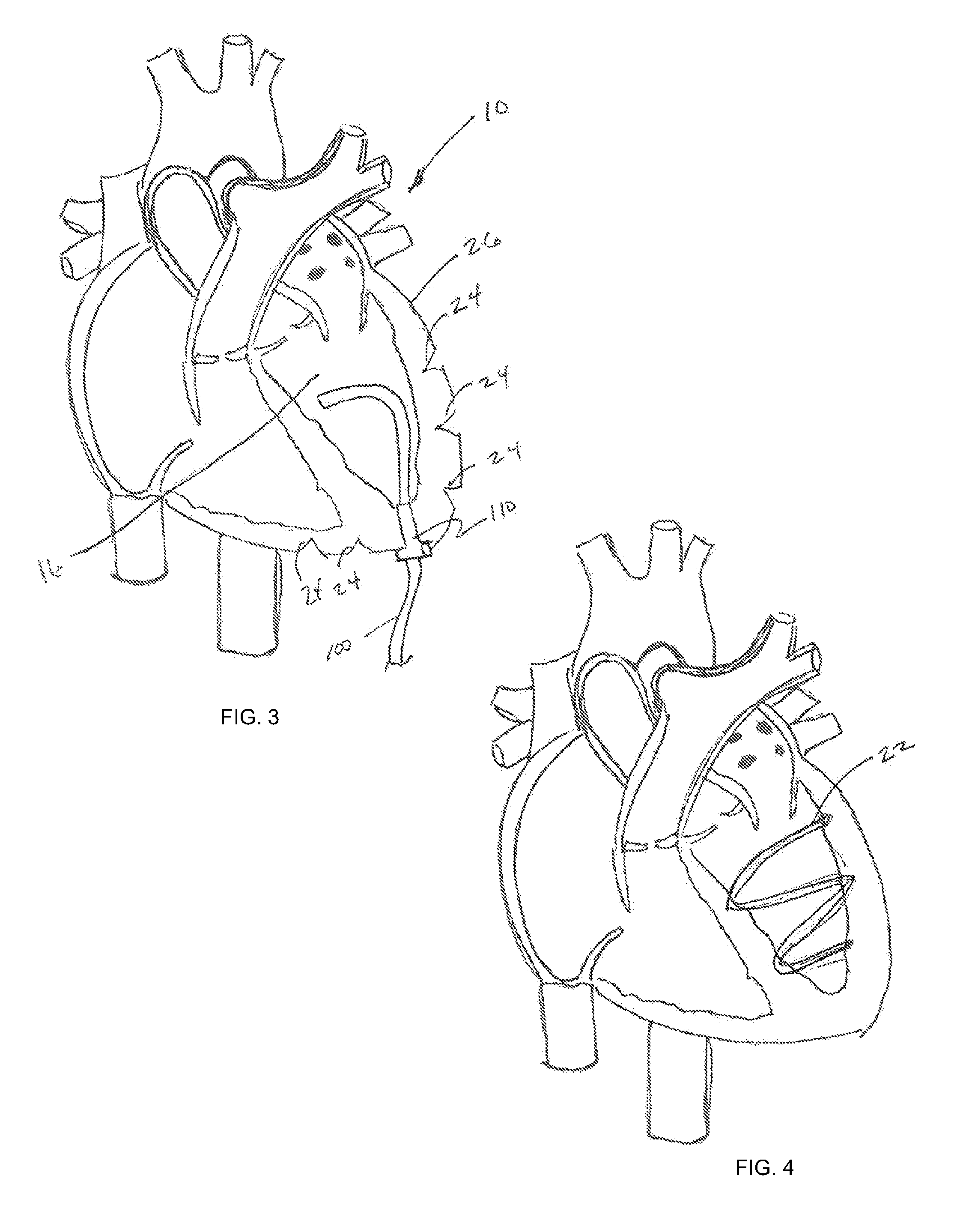 Methods and devices for diastolic assist