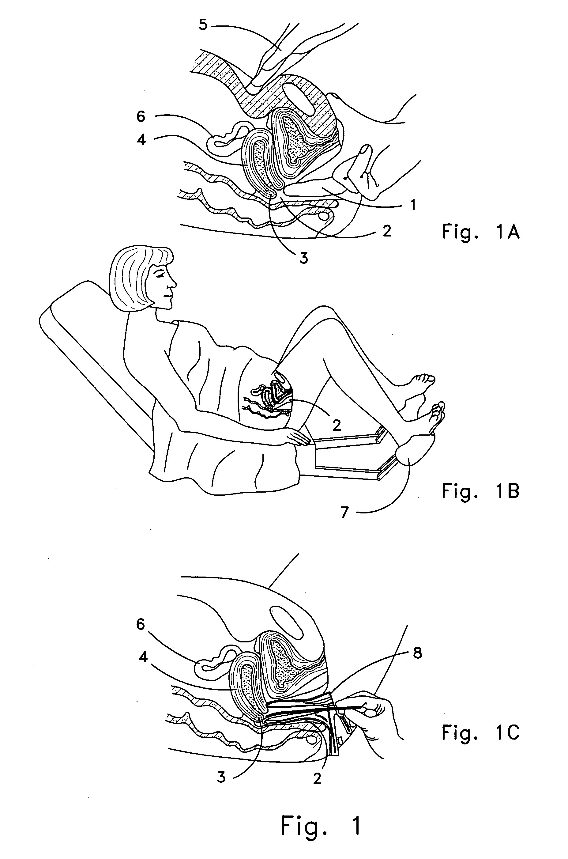 Apparatus and method of personal screening for cervical cancer conditions in vivo