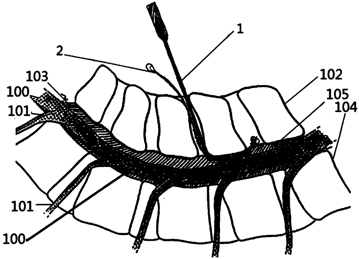 Fretsaw guiding device, spinal vertebral plate excision method and spinal nerve root anatomy method